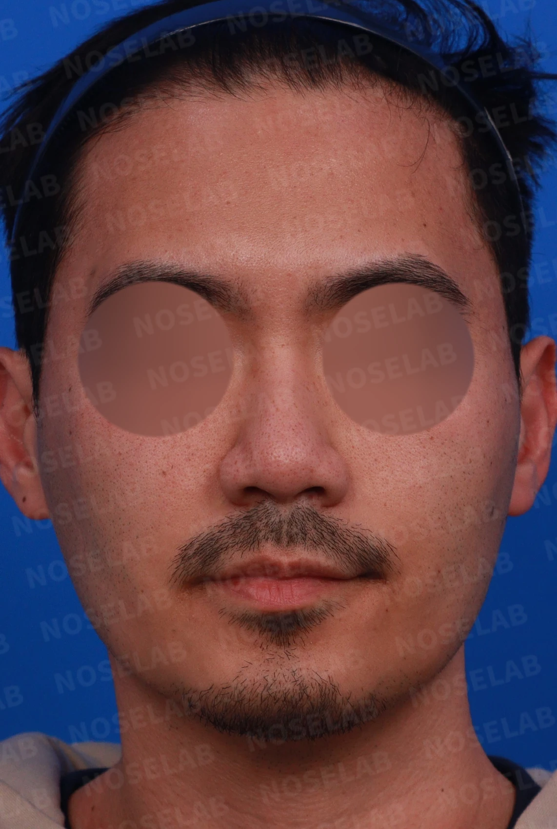 복코에 비공 비대칭과 코막힘이 함께 오는 이유, 직반 라인 교정은 어떻게 하나 — 디자인 상담 정면, 좌측 측면, 비스듬한 측면 사진