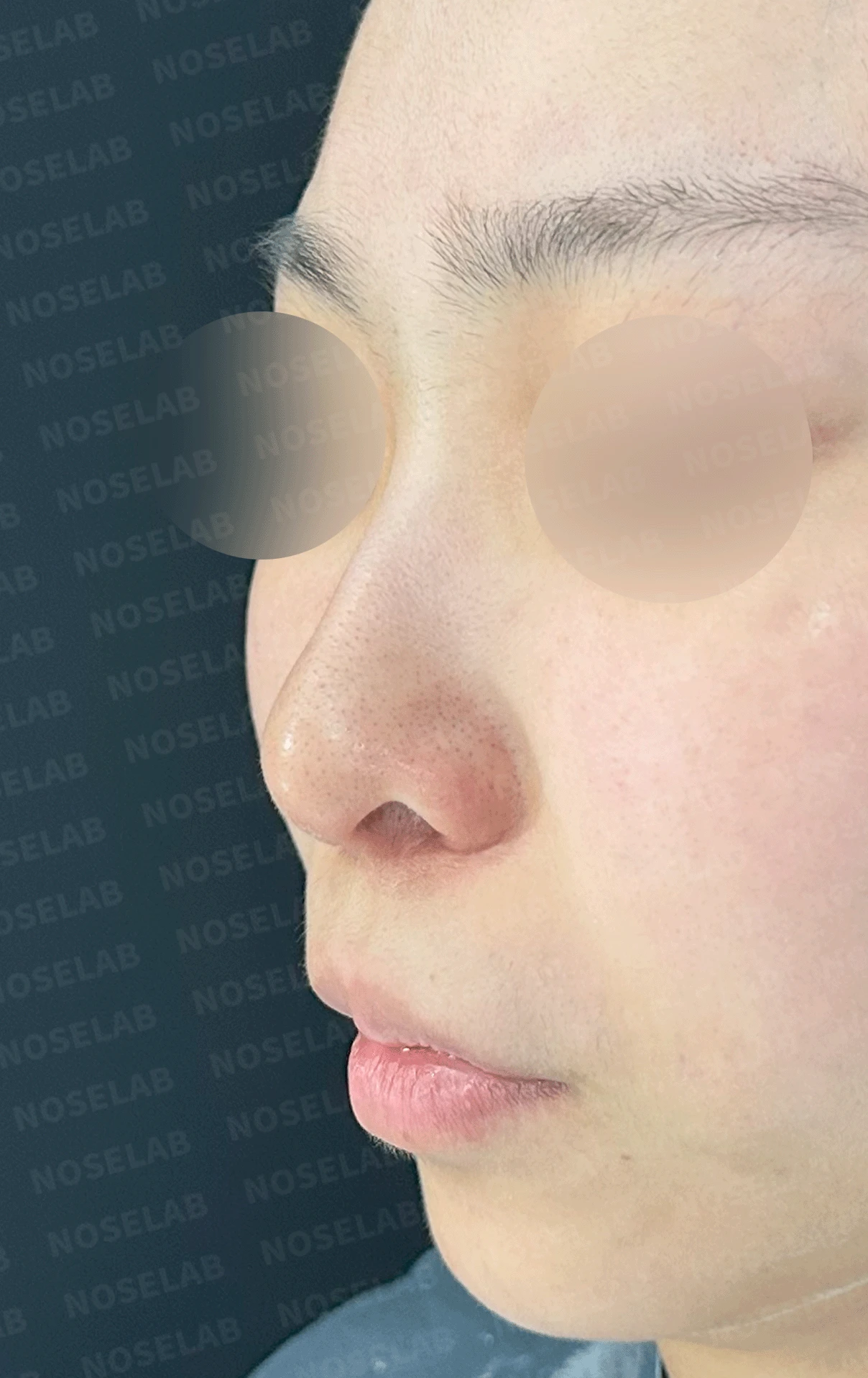 여러 번 수술해도 콧대가 낮고 복코가 남는 이유, 늑연골 재건과 얼굴 균형 — 본문 사진 11