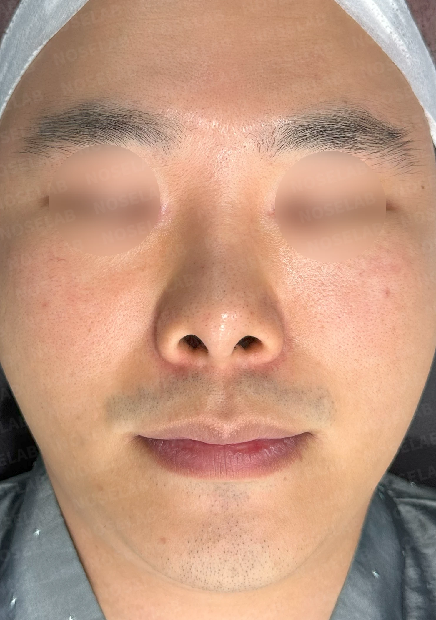 비중격 연골을 많이 쓴 코가 들리고 막히는 이유, 재건은 어떻게 하나 — 수술 전 / 수술 직후 0일 직후 사진은 부기가 있는 상태로 최종 결과와 다를 수 있습니다.