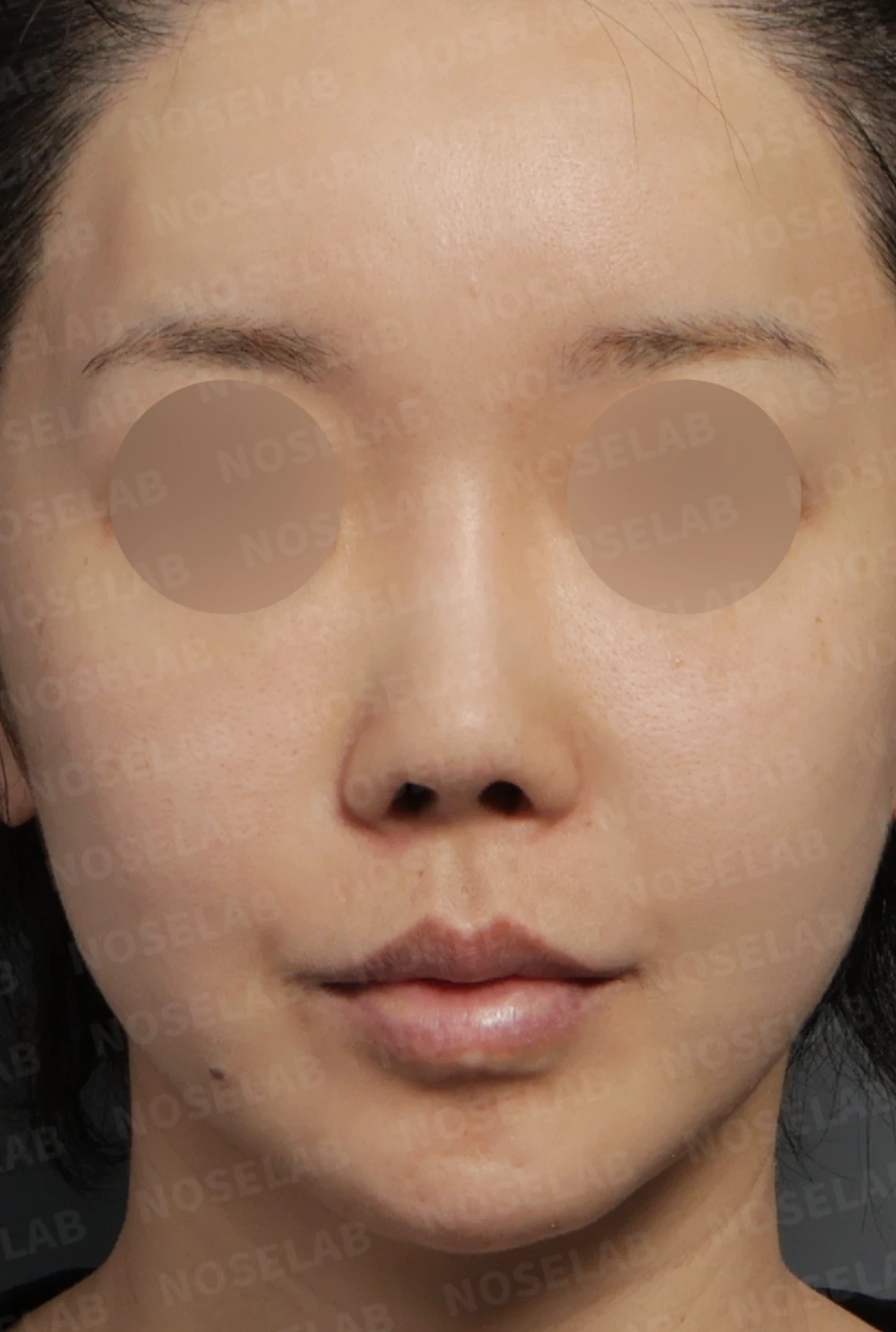 짧고 들린 코, 자가늑연골로 비중격 재건한 코재수술 사례 — 디자인 상담 정면 , 좌측 비스듬한 측면 , 측면 사진입니다.