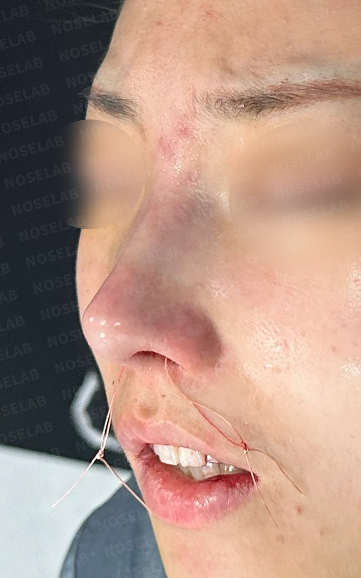 휘어진 코 교정과 비염 개선 - 자가늑연골 재건술 후기 — 직후 정면, 비스듬한 측면, 측면 사진입니다.