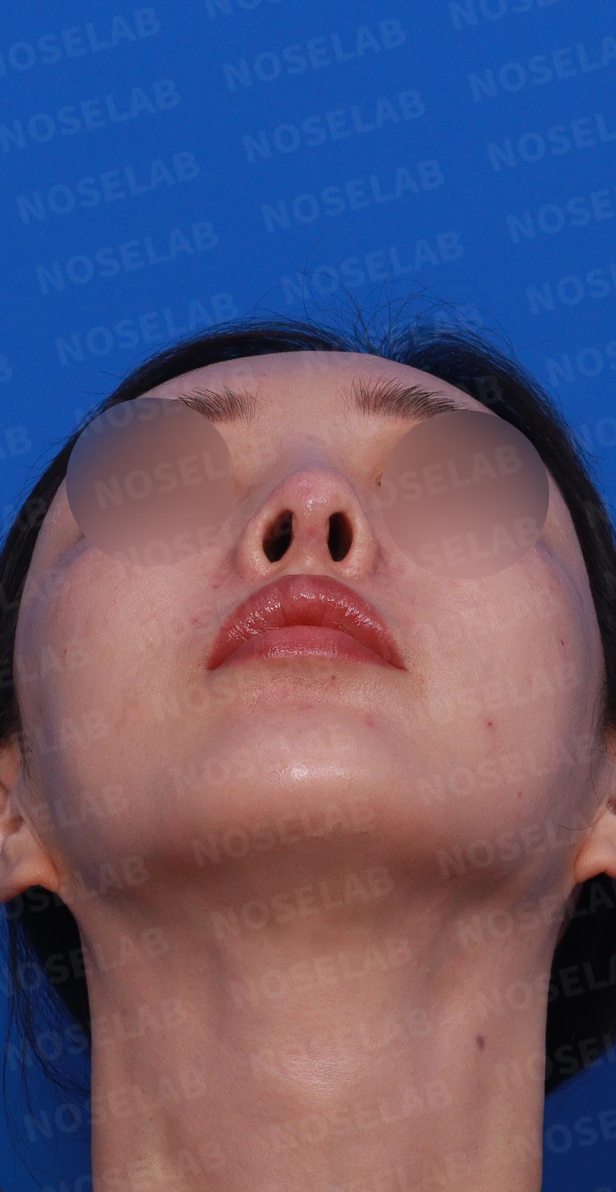 코성형 후 염증이 반복되는 이유와 자가 조직만으로 재건하는 방법 — 디자인 상담 우측 비스듬한 측면 , 측면 , 비공 사진입니다.