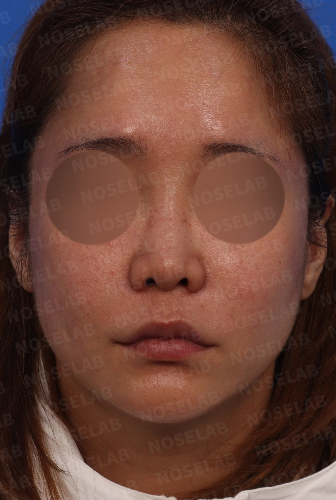 코에 주입된 칼슘필러의 제거와 재건 방법 — 코가 전체적으로 작고 짧음 필러로 인해 미간이 퍼져 있고 부자연스러움 콧대가 우측으로 휘어 보임 콧구멍이 많이 보이는 편 콧볼 축소수술로 인한 비대칭이 눈에 띔 측면 사진: