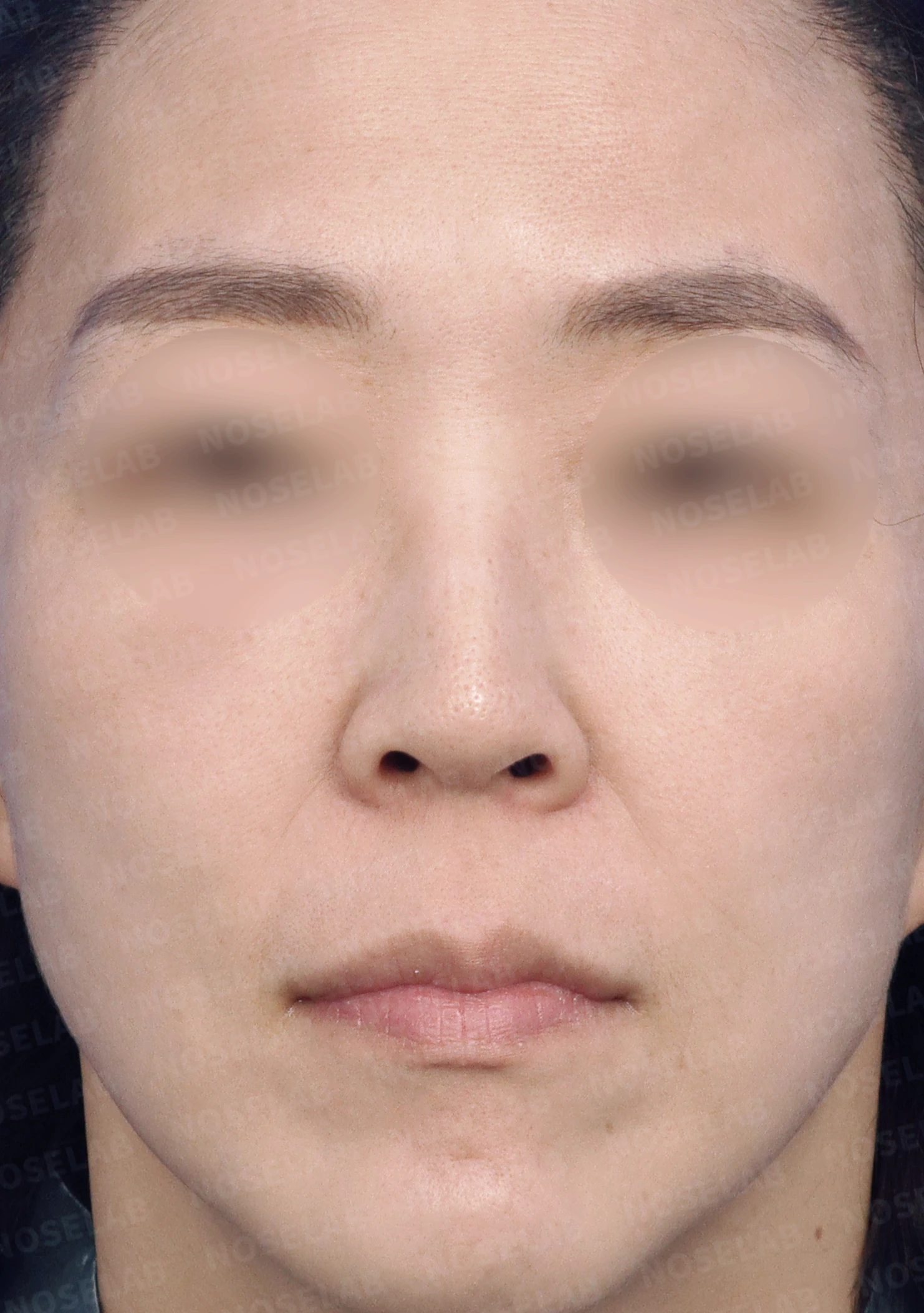 들창코, 매부리코, 휜코까지 한번에 완벽 교정! — 수술전(좌) 수술직후(우)
