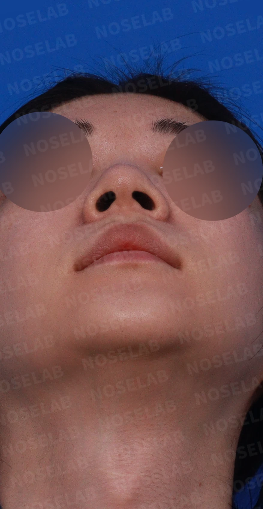 코가 뭉툭하고 퍼져 보이는 이유, 비순각과 비주는 어떻게 교정하나 — 디자인 상담 우측 비스듬한 측면, 측면, 비공 사진