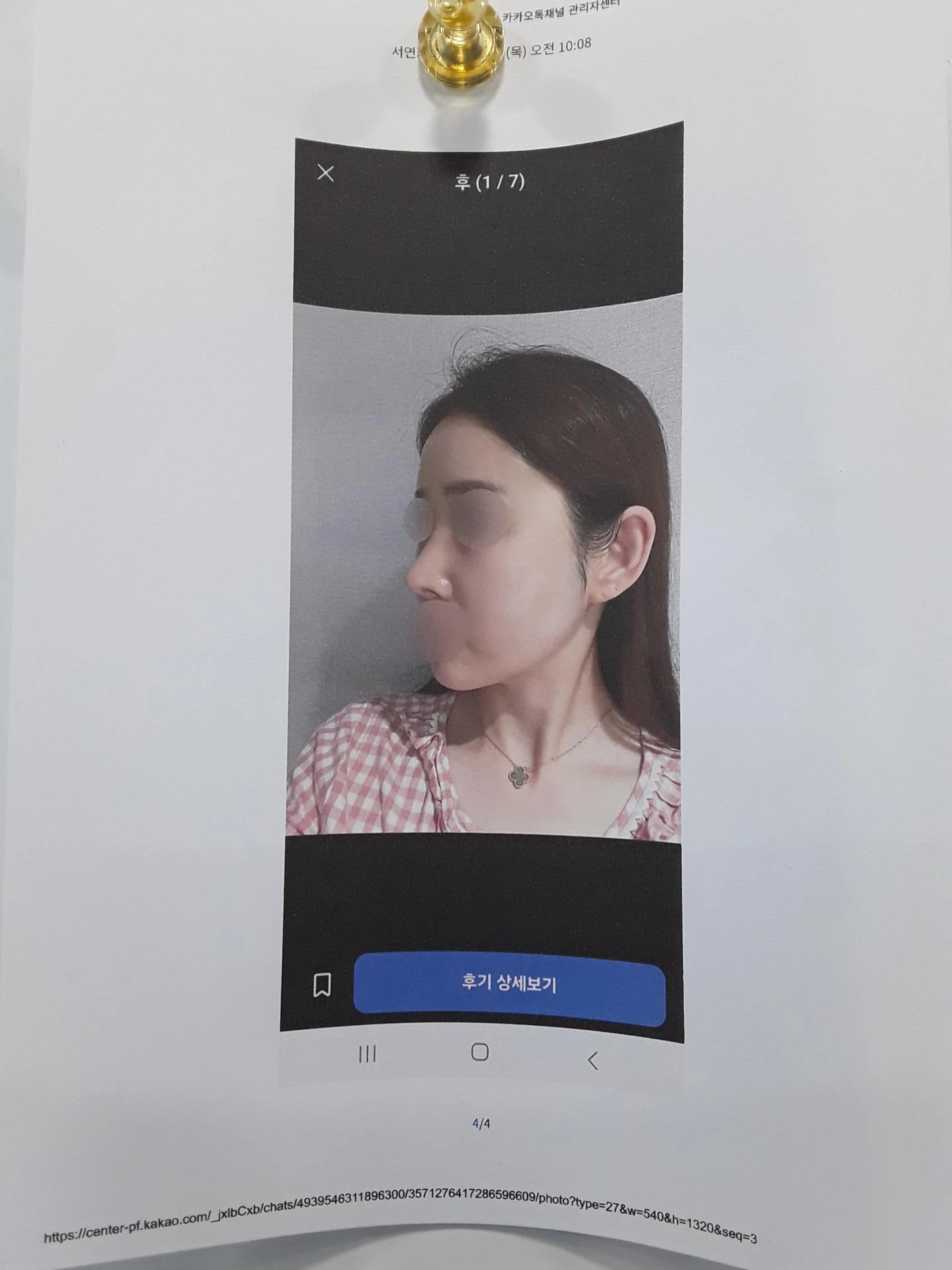코 수술 뒤 염증이 오래 지속되면 생기는 변화와 재건 방법 — 환자분 요구사항 사진들