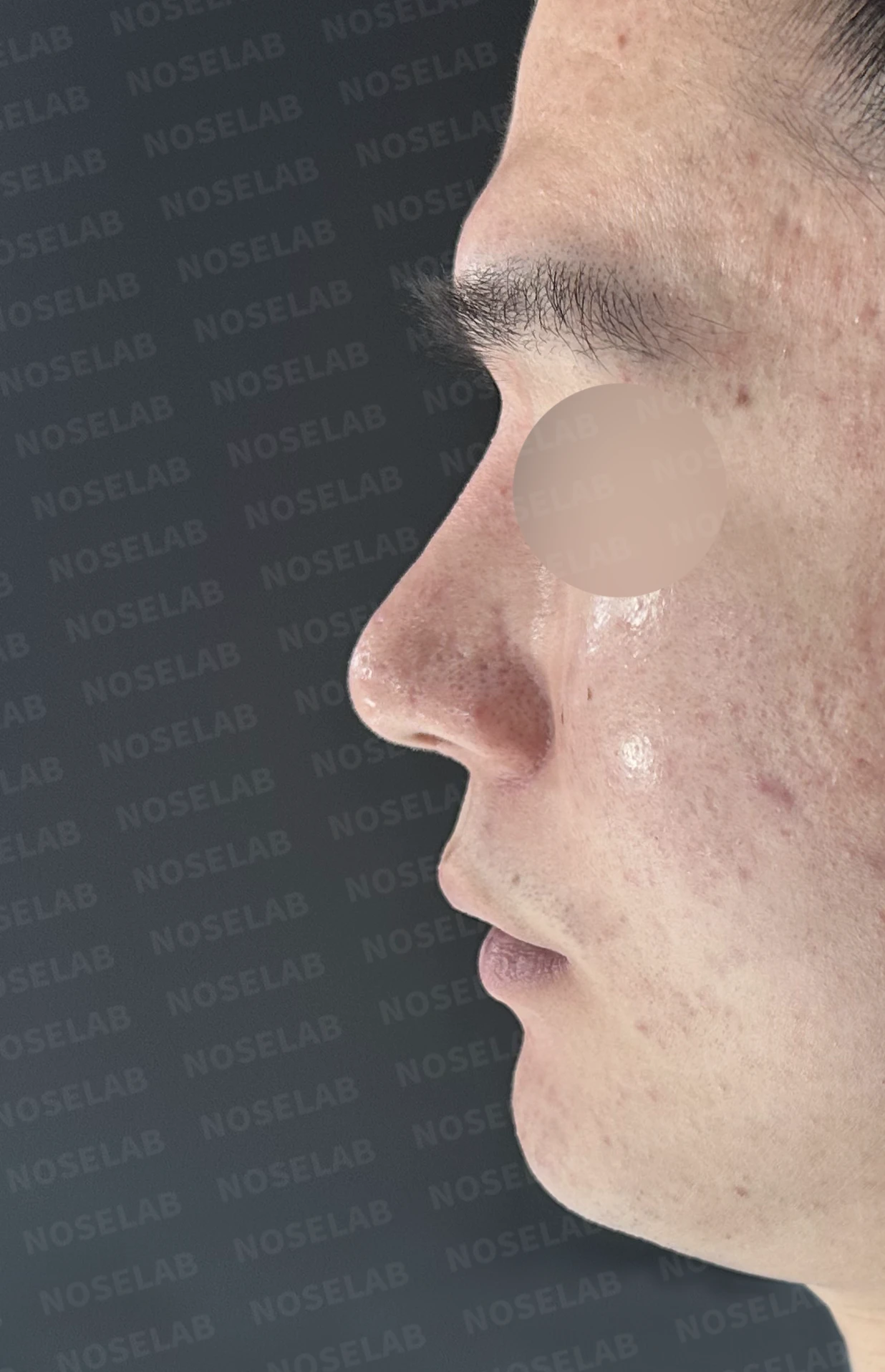 콧대를 더 높이고 싶을 때 무엇이 한계를 만드나, 3D 맞춤 보형물과 자가늑연골 코끝 지지 — 수술 전 / 수술 직후 0일 직후 사진은 부기가 있는 상태로 최종 결과와 다를 수 있습니다.