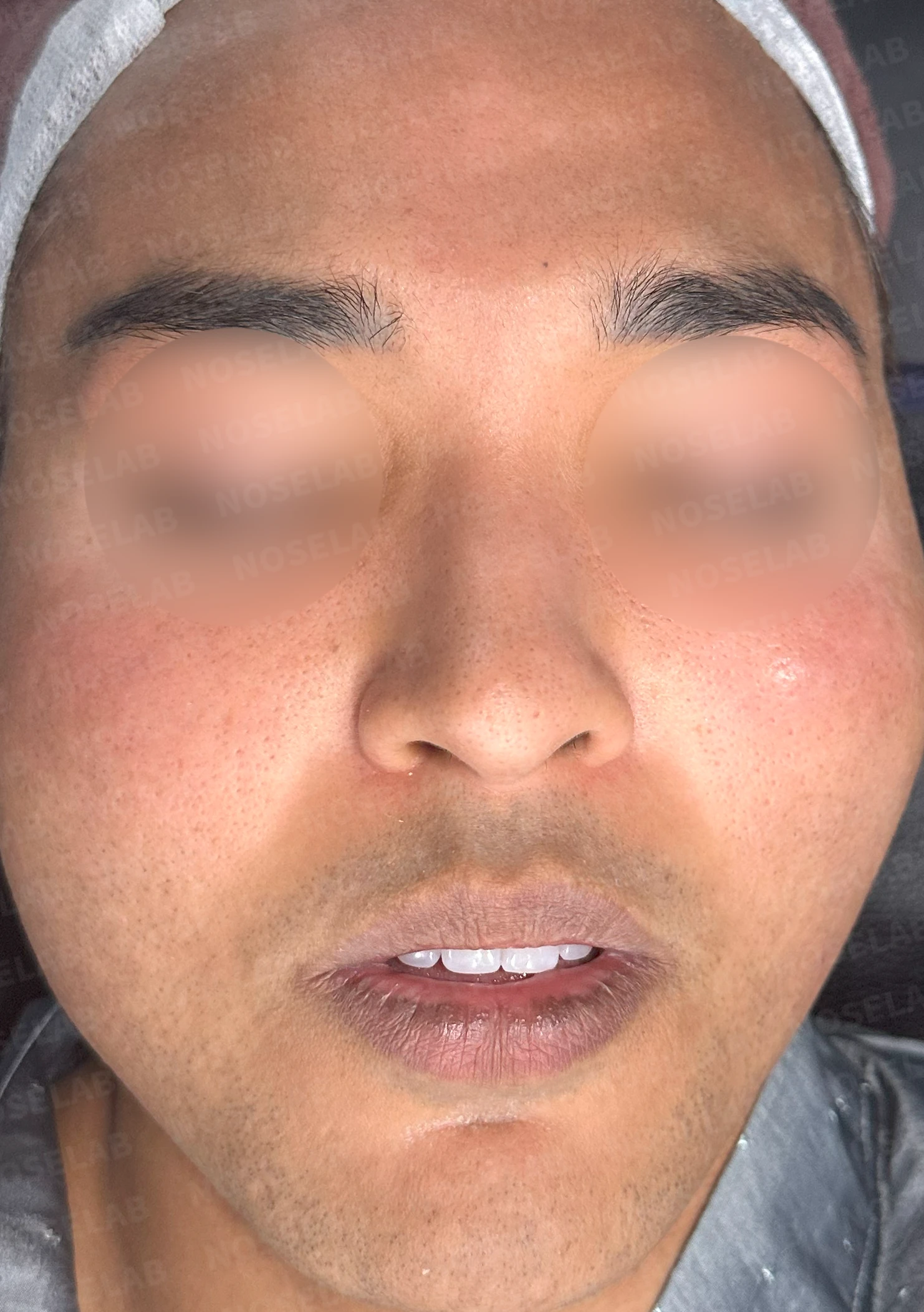 코가 퍼져 보이면서 코막힘이 함께 오는 이유, 절골과 자가 늑연골 교정 방법 — 수술 전 / 수술 직후 0일 직후 사진은 부기가 있는 상태로 최종 결과와 다를 수 있습니다.