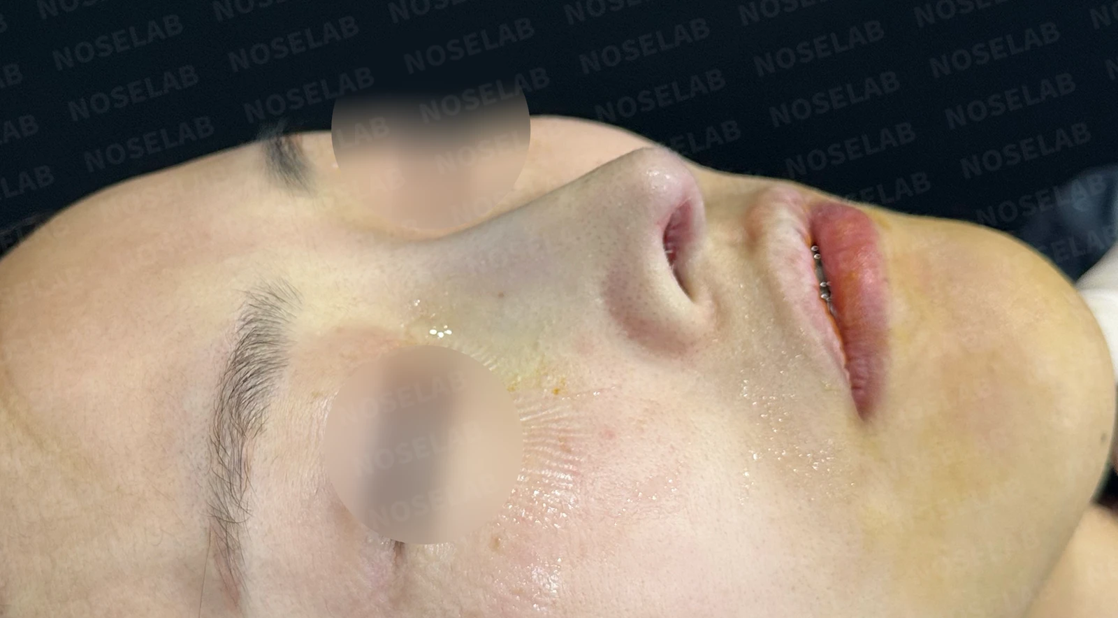피부가 얇고 작은 들창코의 비대칭과 기능 교정 방법 — 수술 전 / 수술 직후 0일 직후 사진은 부기가 있는 상태로 최종 결과와 다를 수 있습니다.