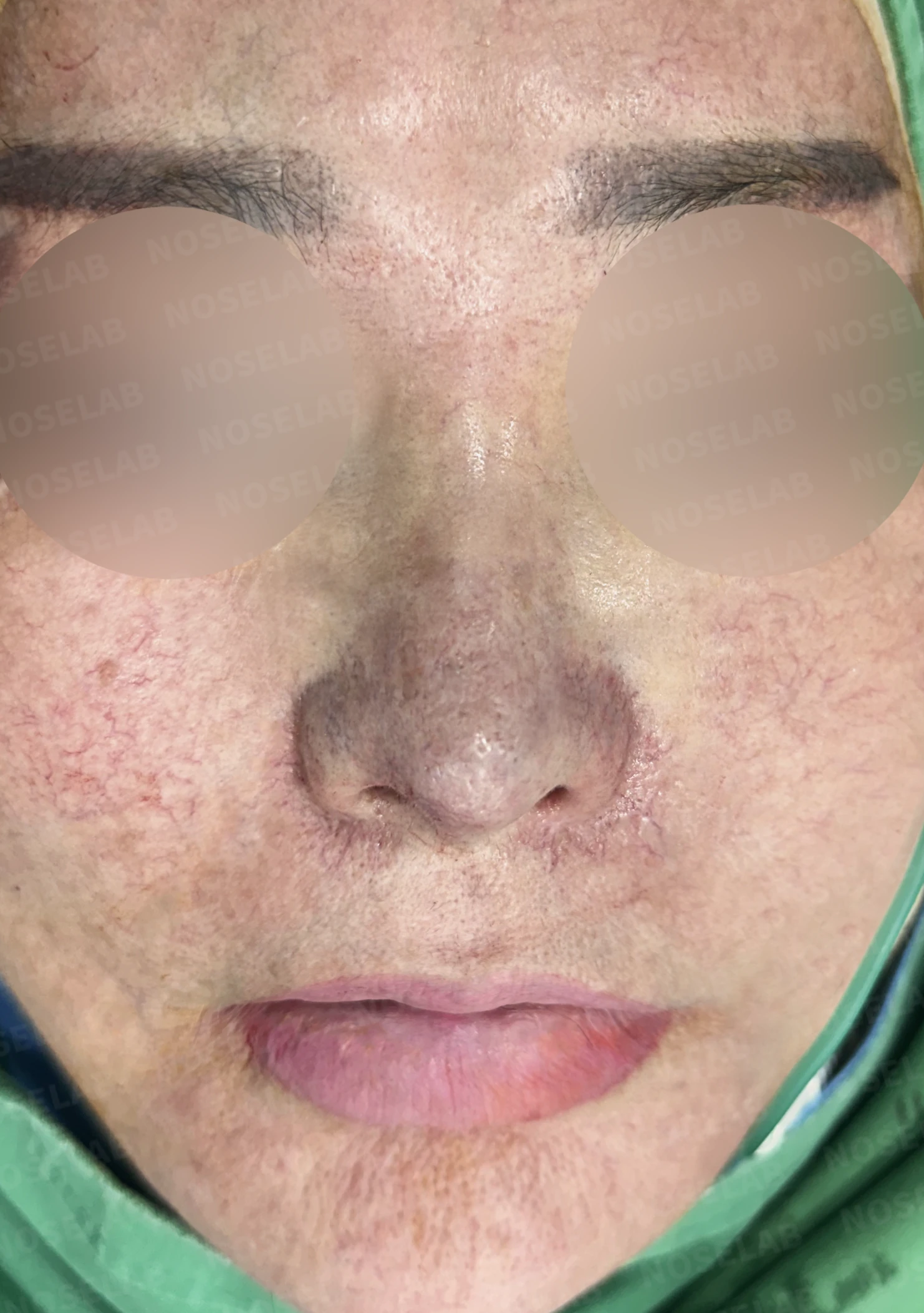 보형물 염증으로 손상된 코, 휴식기 후 기증늑연골로 안전하게 재건한 코재수술 — 전(좌) 직후(후)