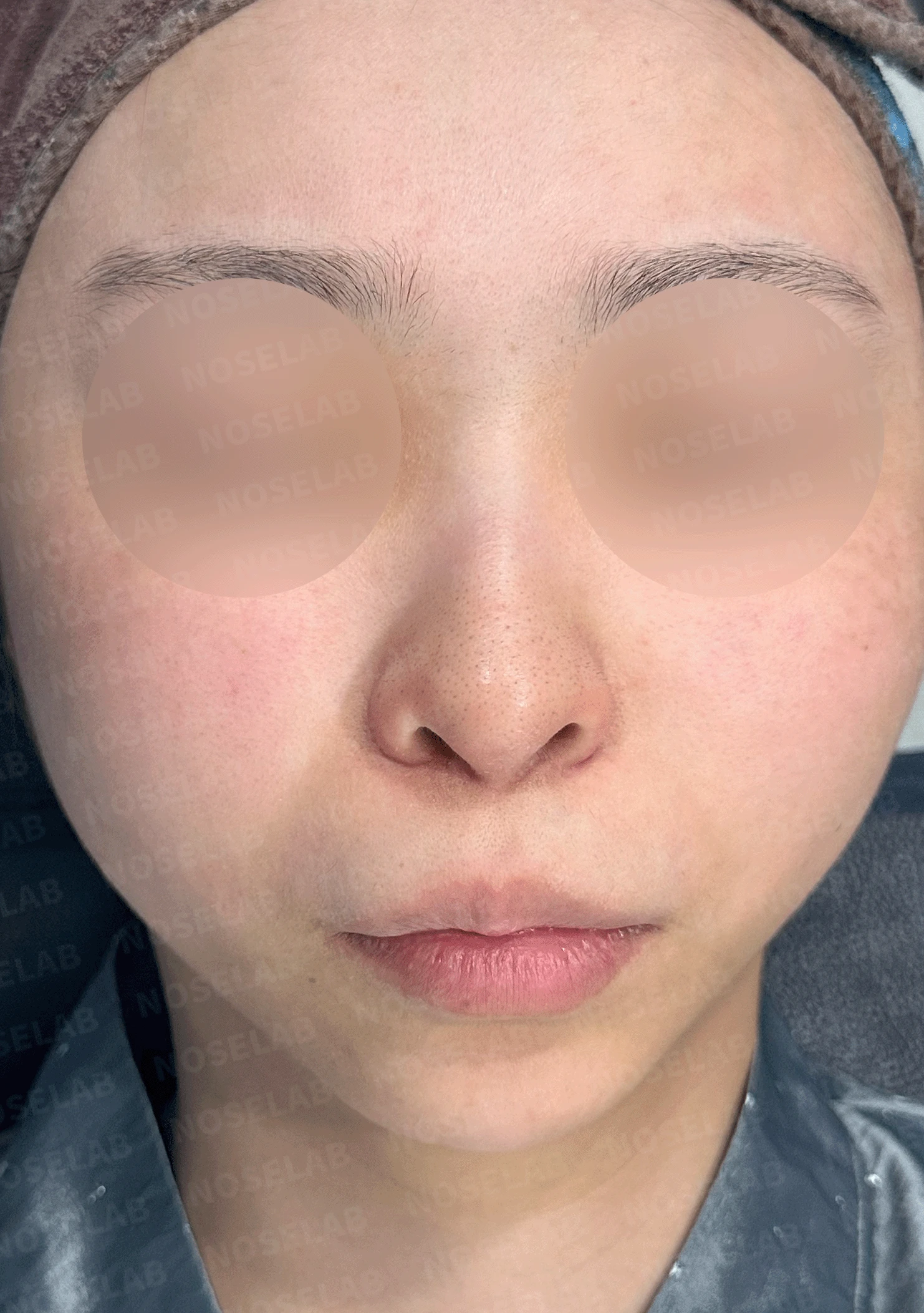 여러 번 수술해도 콧대가 낮고 복코가 남는 이유, 늑연골 재건과 얼굴 균형 — 본문 사진 7