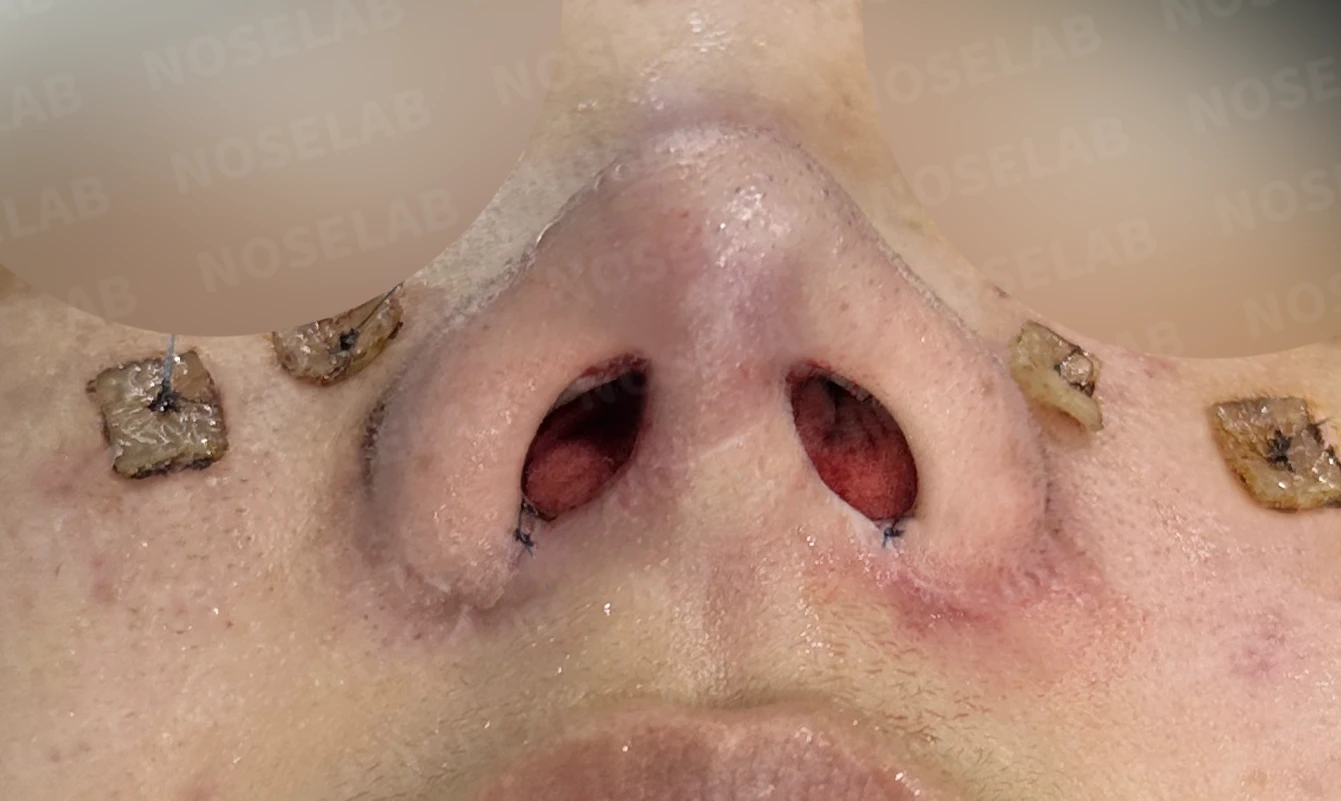 메드포어로 손상된 비중격, 자가늑연골로 완벽하게 재건하다 — 수술직후 비공 사진입니다.