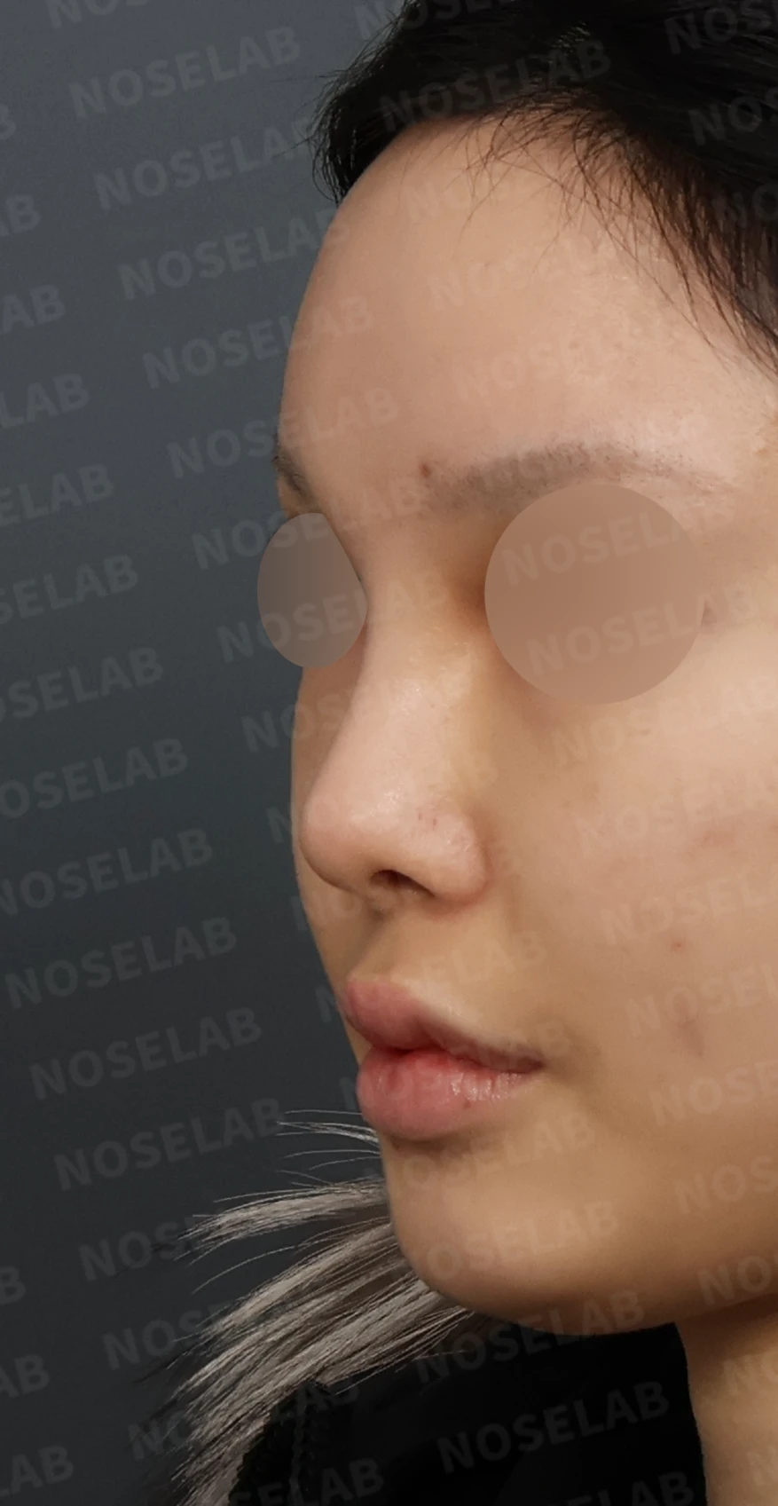 심한 비중격 만곡과 높은 콧대 시작점, 기증늑연골로 정밀 재건 — 디자인 상담 정면, 좌측 측면, 비스듬한 측면 사진입니다.