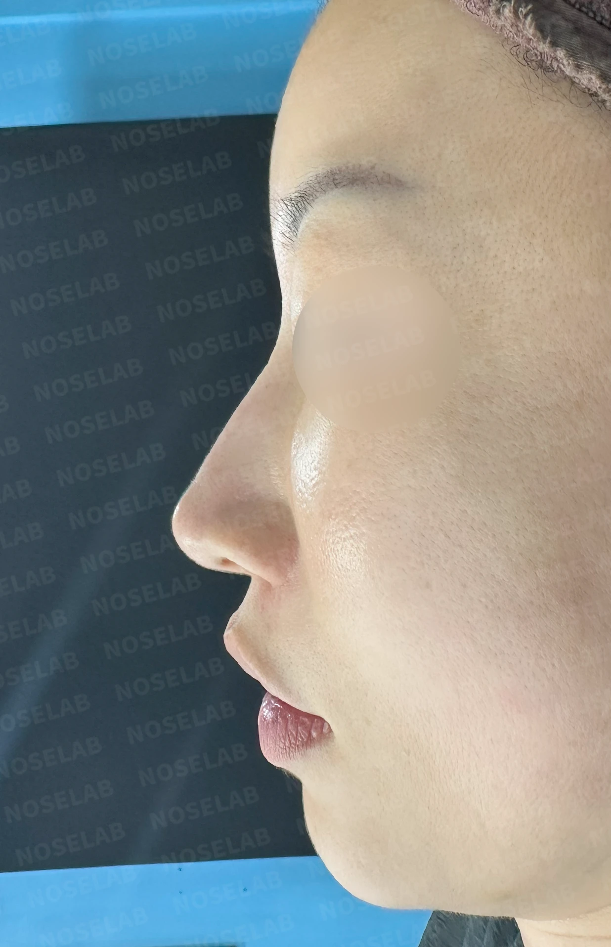 충격을 받은 뒤 코끝에서 소리가 나고 모양이 달라지는 이유와 늑연골 재건 — 본문 사진 9