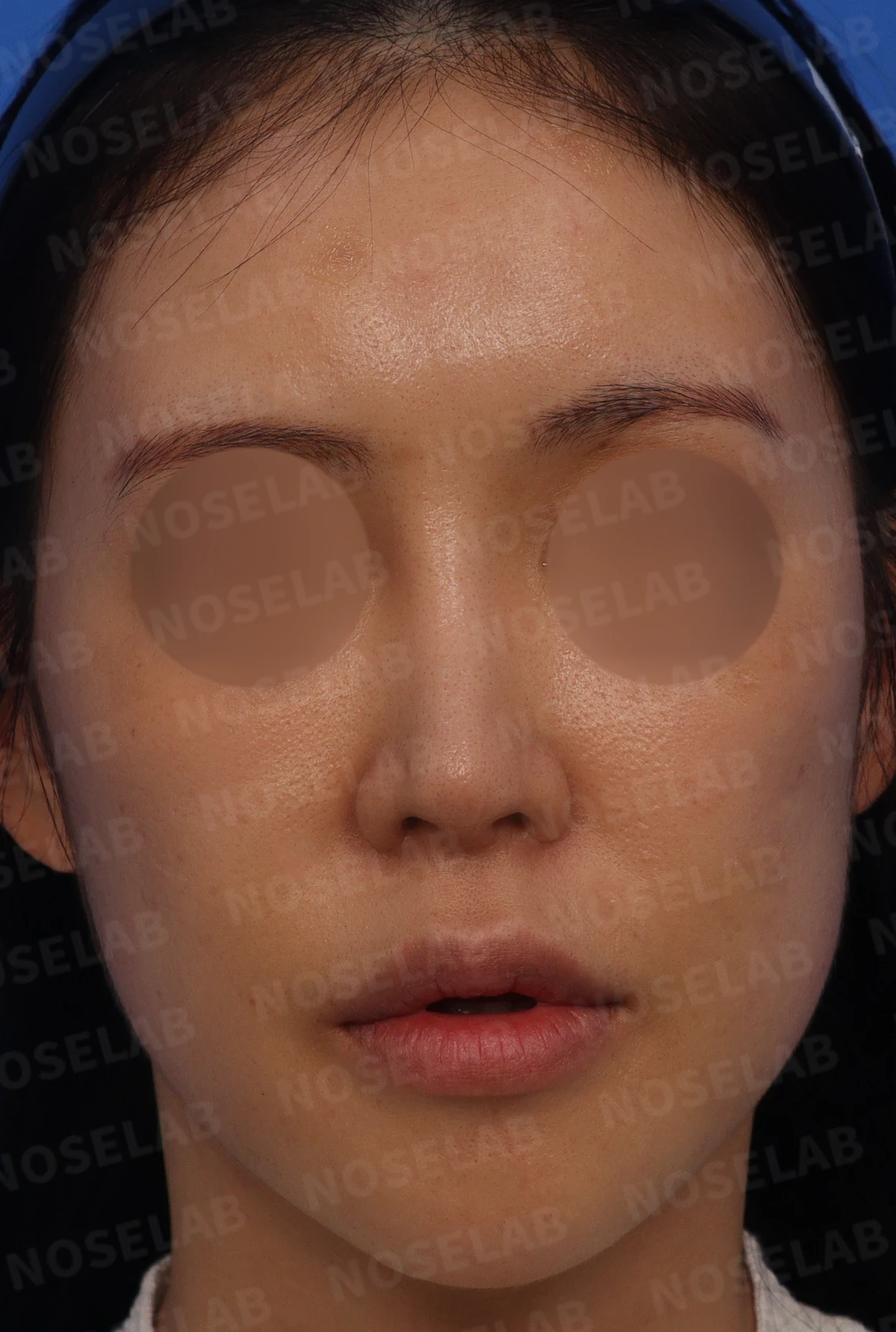 높은 콧대 시작점을 낮추는 방법 — 비스듬한 측면 사진: 미간 시작점이 높아서 콧대 라인이 매우 부자연스러움 코끝의 처짐이 확연히 보임
