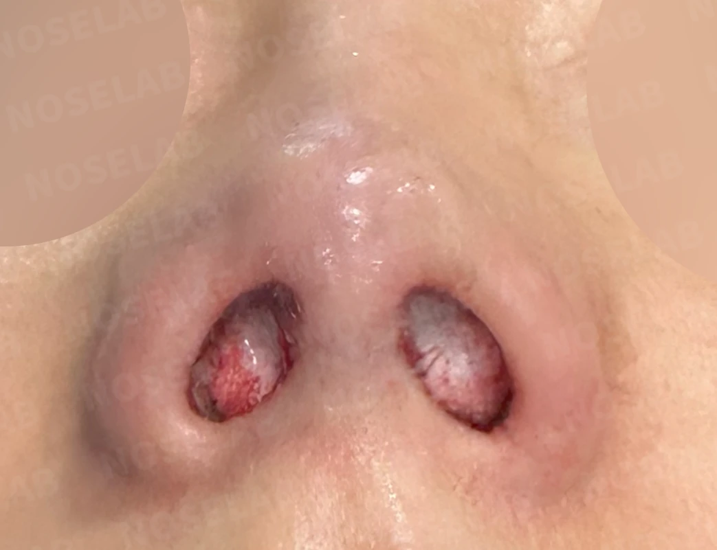 기증 늑연골이 흡수되면 코가 어떻게 변하고, 자가 늑연골 재건은 어떻게 하나 — 수술 직후 0일 비공 사진 직후 사진은 부기가 있는 상태로 최종 결과와 다를 수 있습니다.