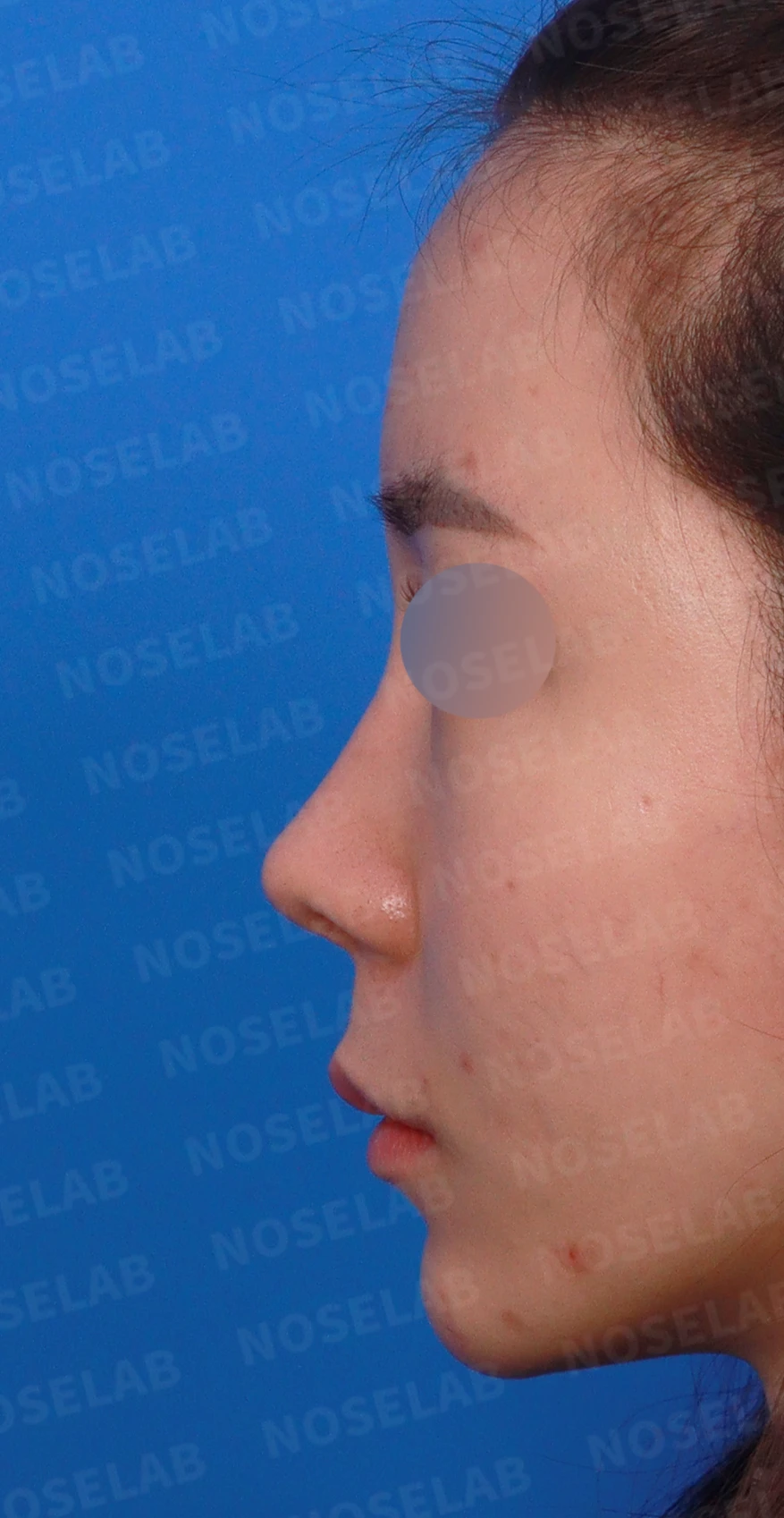 비주가 길어 보이는 이유와 코끝 연골 재배치 방법 — 디자인 상담 정면, 좌측 측면, 비스듬한 측면 사진입니다.