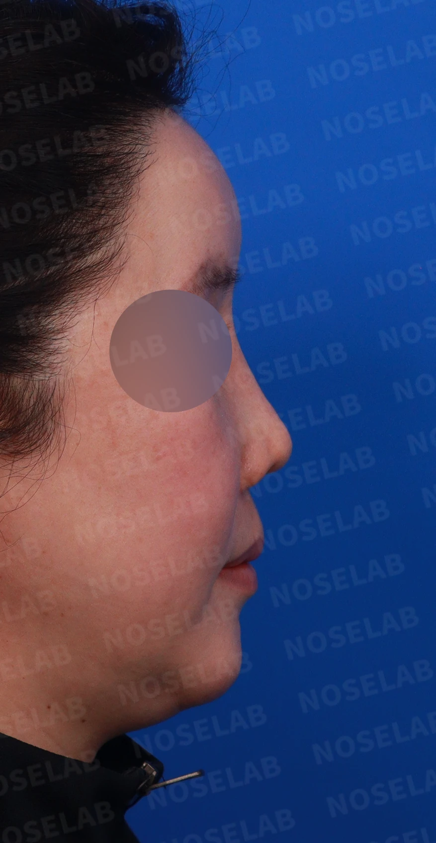 귀족수술 보형물이 코 안으로 밀려 나와 숨이 막히는 이유와 재건 방법 — 디자인 상담 우측 비스듬한 측면, 측면, 비공 사진입니다.