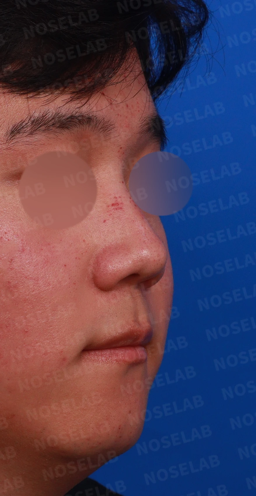 복코와 들린 코, 얼굴 비율을 고려한 교정 방법 — 우측 측면, 비스듬한 측면, 비공 사진
