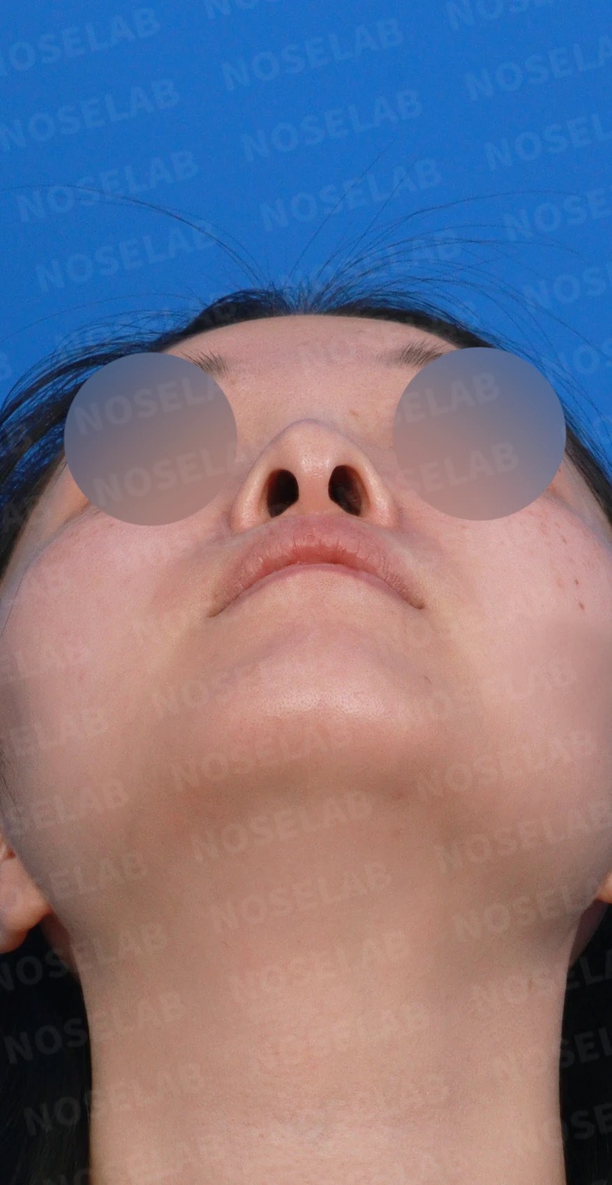 처진 비주 교정, 휜 코와 비공 비대칭까지 완벽하게 — 디자인 상담 우측 측면, 비스듬한 측면, 비공 사진입니다.