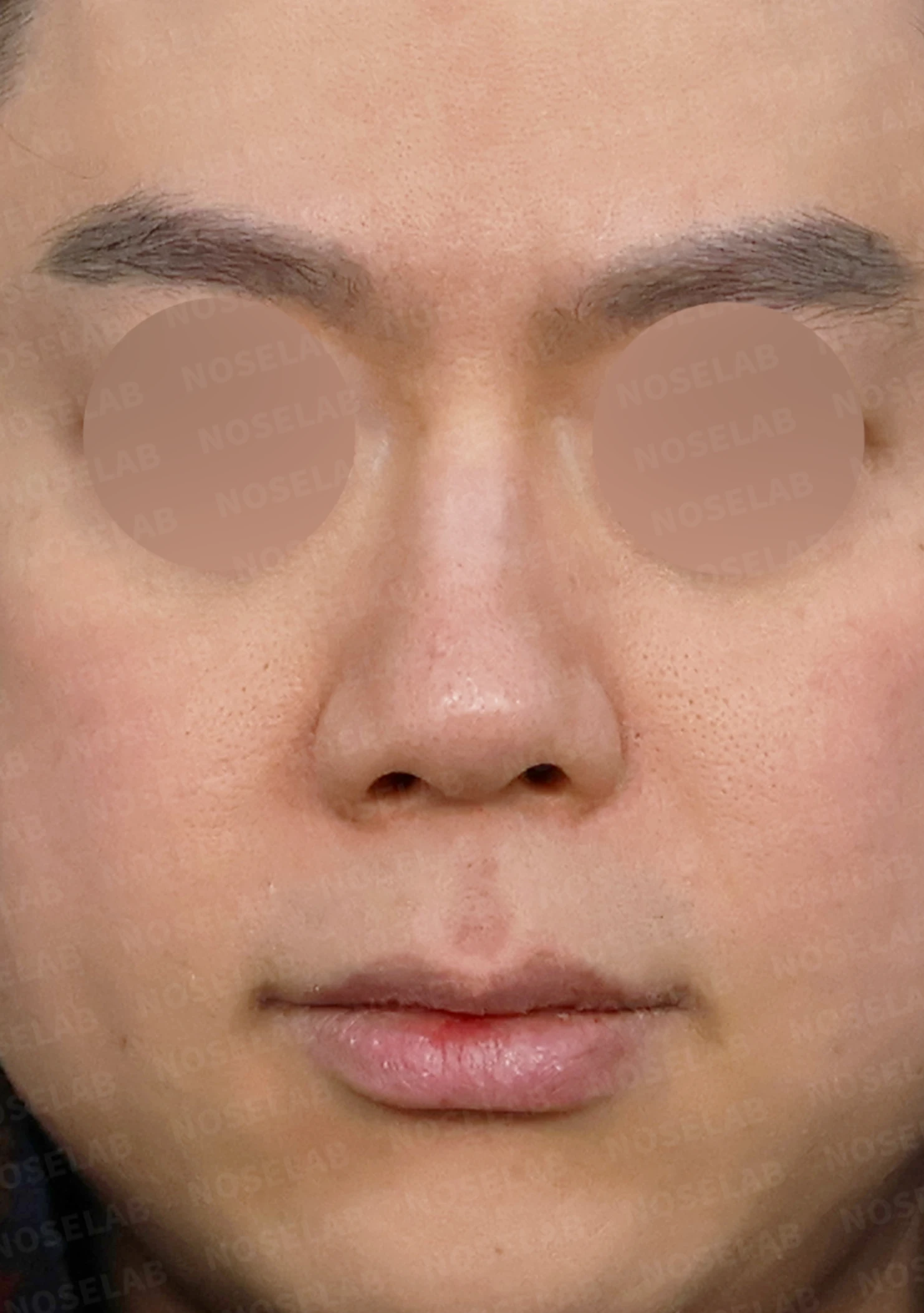 휘어진 매부리코, 자가늑연골로 교정한 남자 코성형 사례 — 전(좌) , 직후(우)