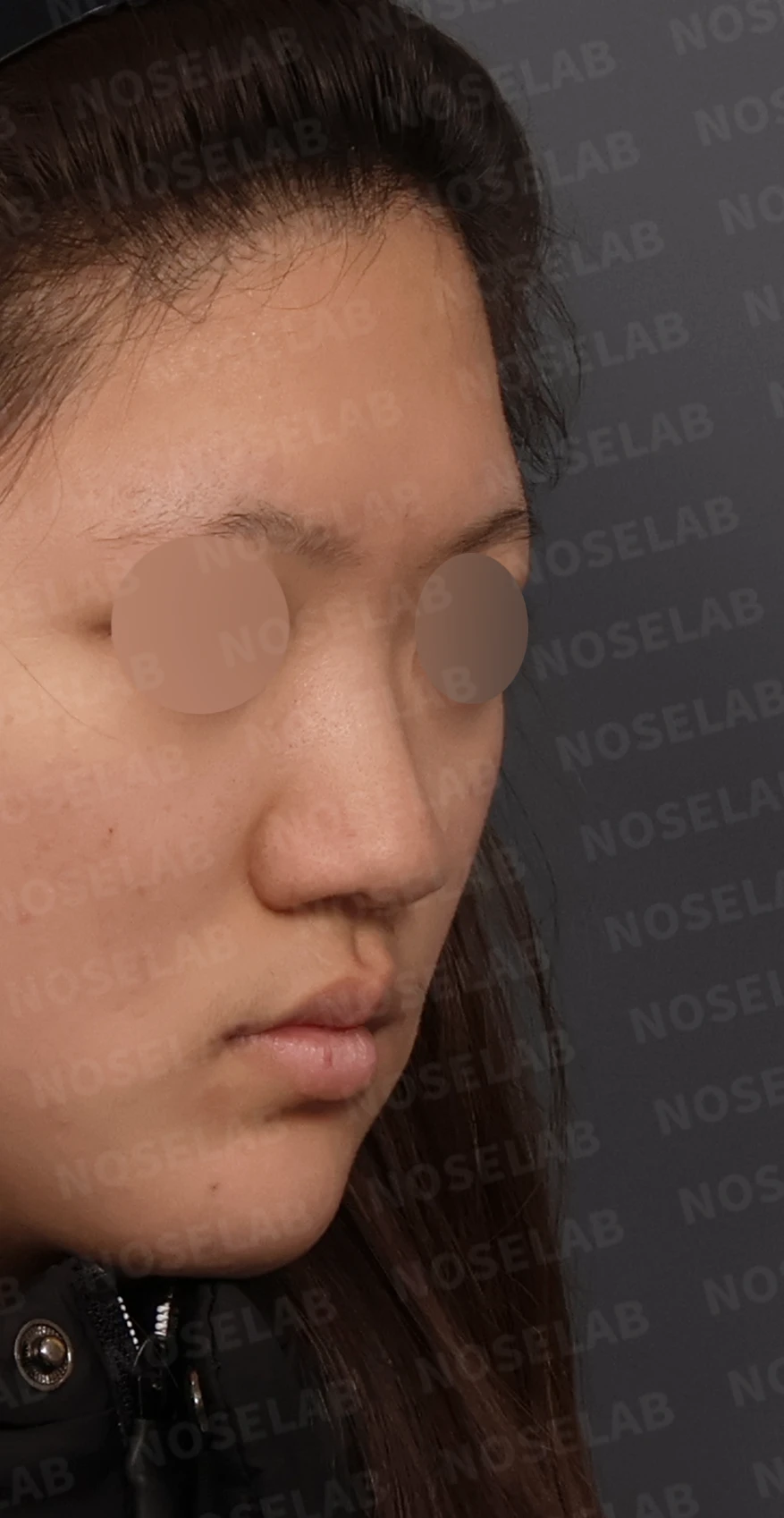 뭉툭한 코끝과 퍼진 코, 자가늑연골 비중격 연장술로 자연스럽게 교정 — 디자인 상담 우측 측면, 비스듬한 측면, 비공 사진입니다.