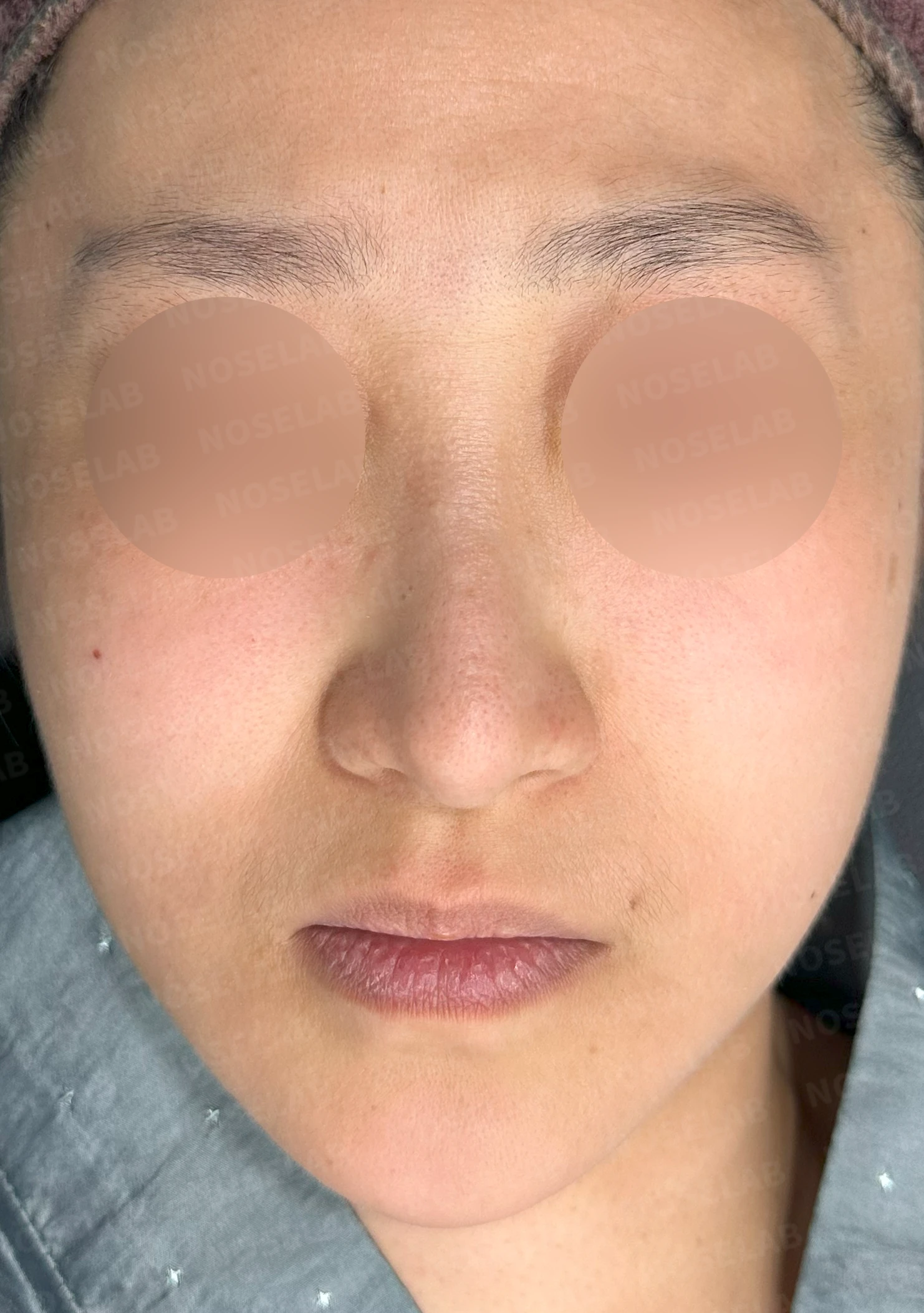 코가 한쪽으로 휘어 보이고 밤에 막히는 이유, 비중격 재건과 코막힘 개선 — 본문 사진 7