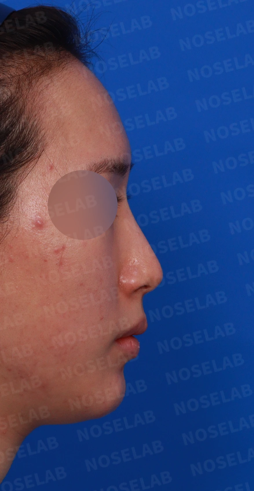 코 필러 뒤에도 휜 코와 코막힘이 남는 이유, 교정은 어떻게 하나 — 디자인 상담 우측 측면, 비스듬한 측면, 비공 사진