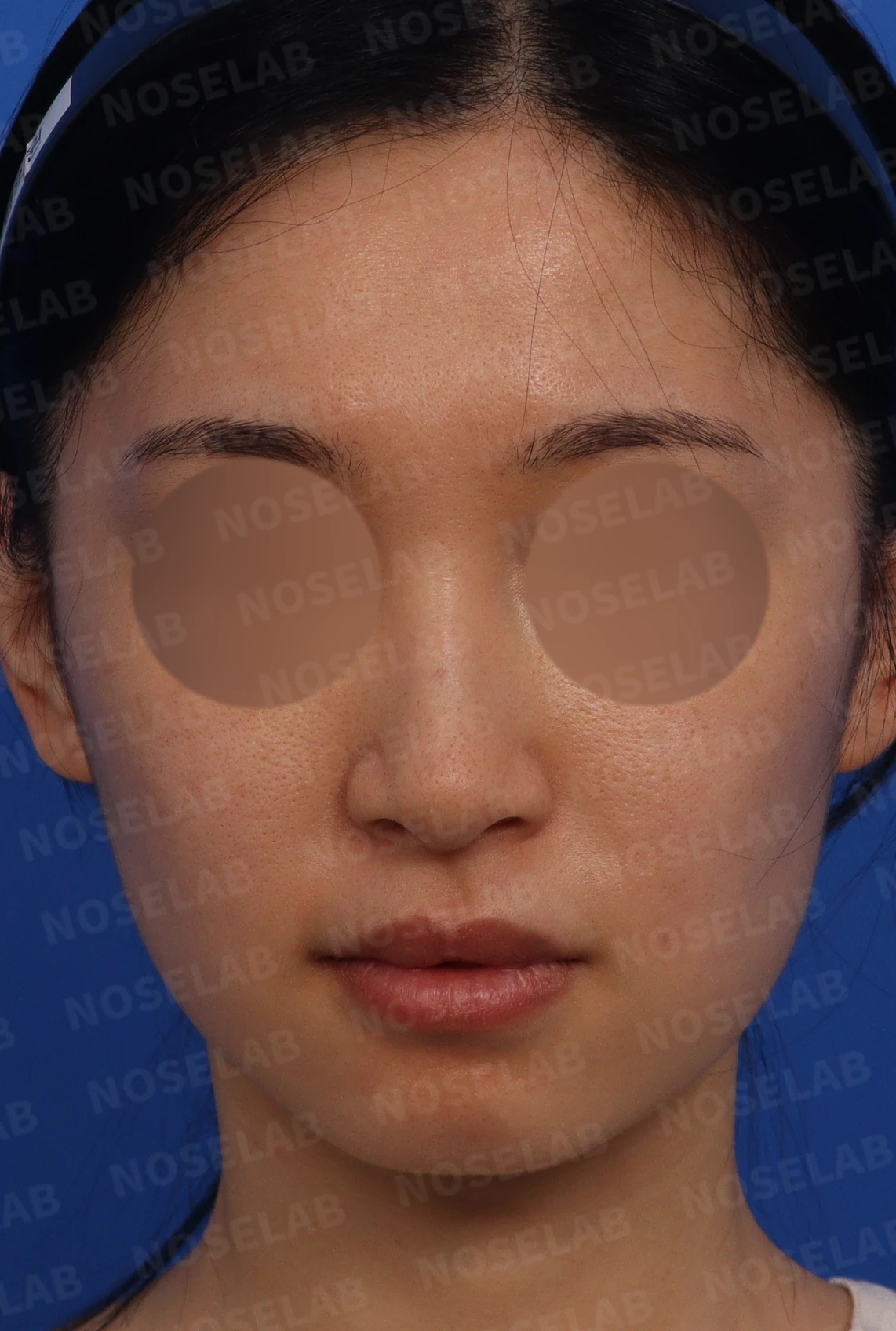 긴 화살코의 코끝과 콧대 교정 방법 — 수술전 디자인 상담 정면, 측면, 비스듬한 측면 사진입니다.
