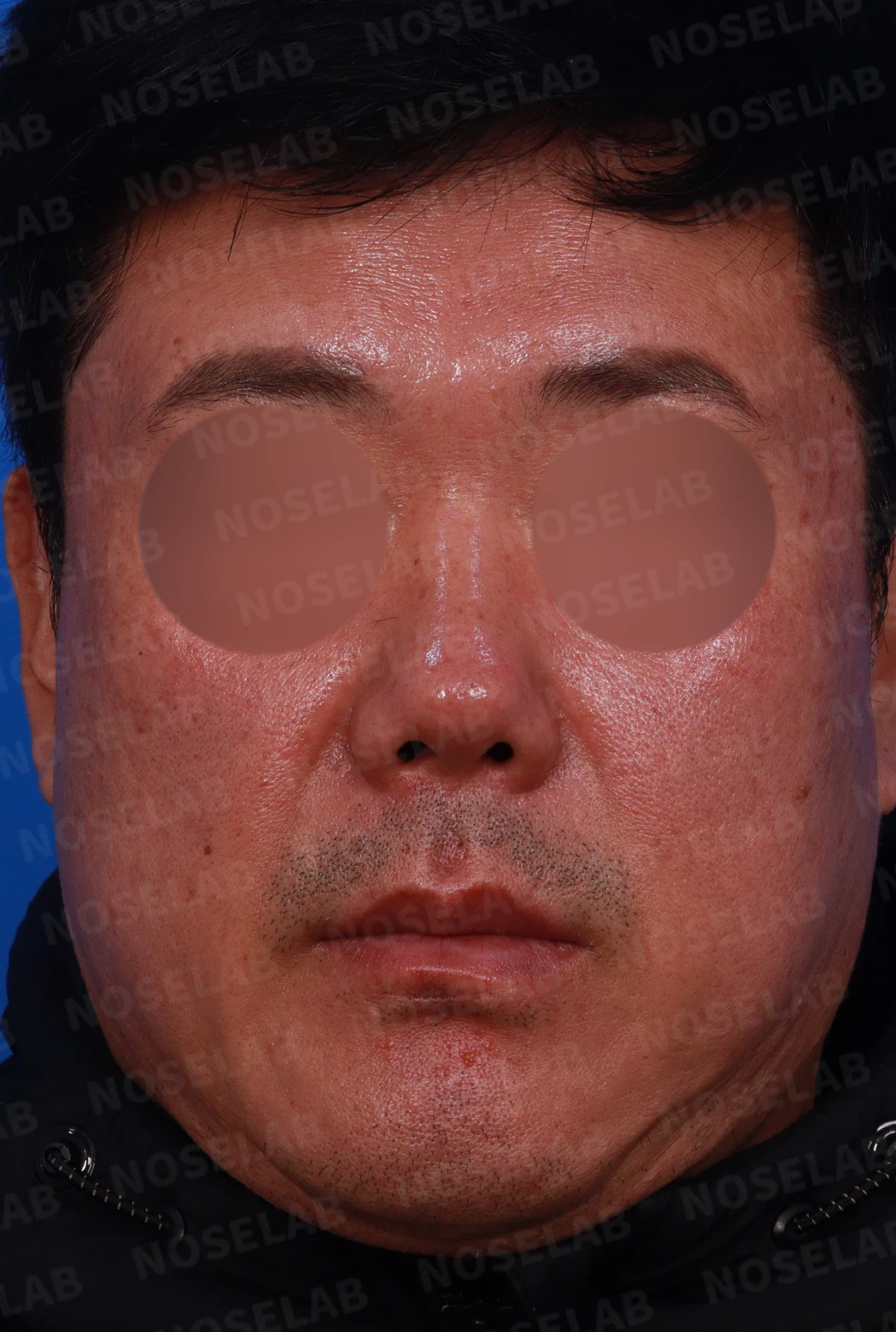짧고 들린 코의 구조와 교정 방법 — 디자인 상담 정면, 좌측 측면, 비스듬한 측면 사진입니다.