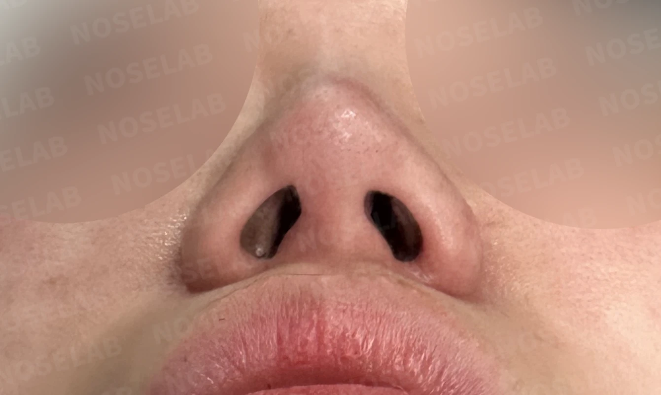 비주 함몰과 콧날개 변형, 자가늑연골을 이용한 코재수술로 자연스럽게 교정 — 전(좌) 직후(후)