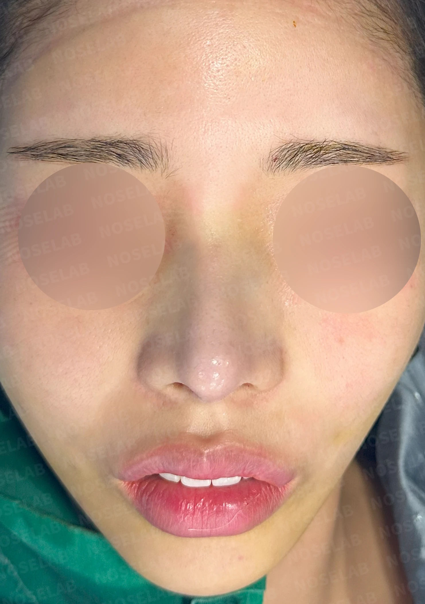 적절하지 않은 L자 실리콘 개선 - 안전한 구조로 재건 후기 — 전(좌) 직후(우)