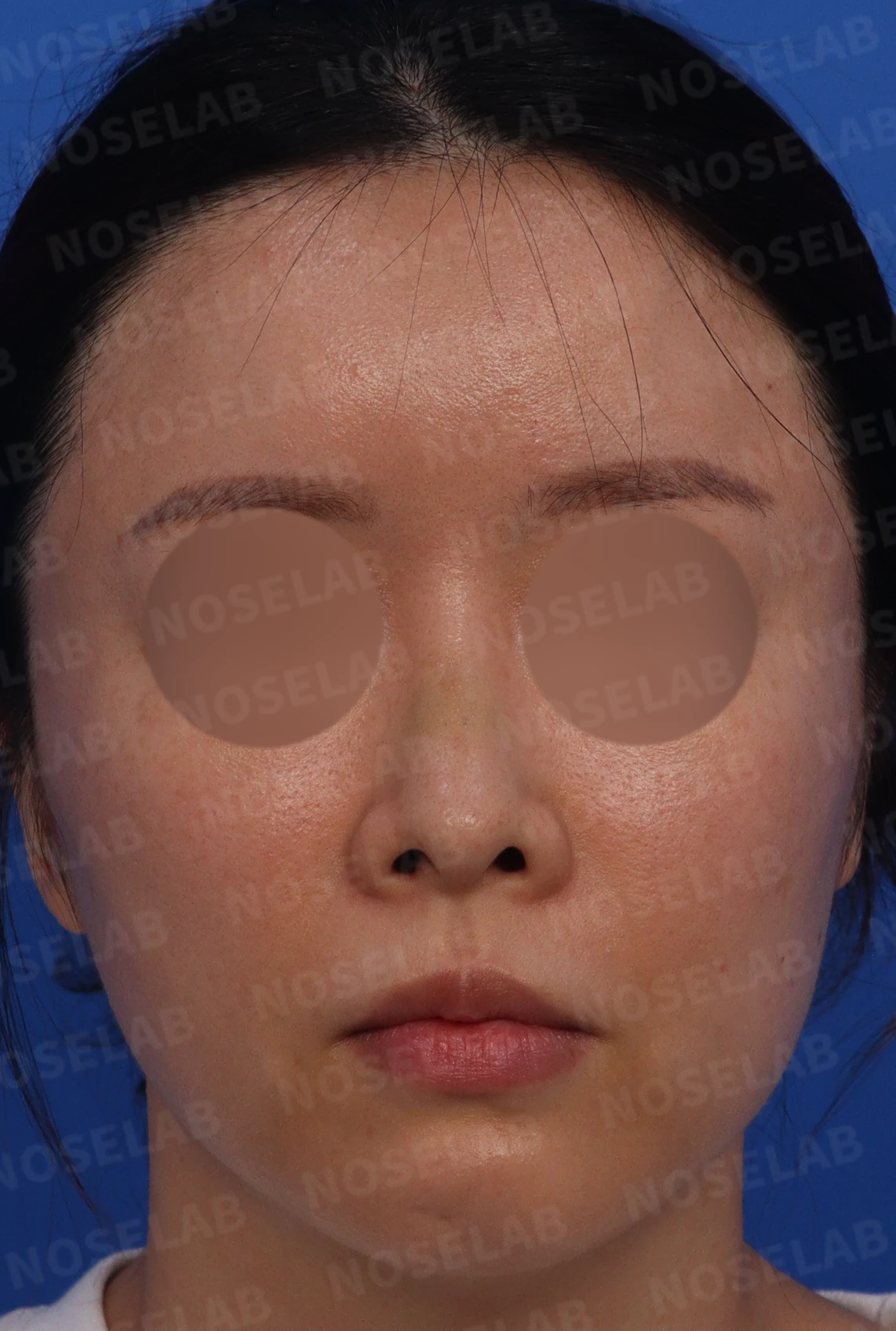 짧고 들린 코를 교정하는 재수술 방법 — 본문 사진 1