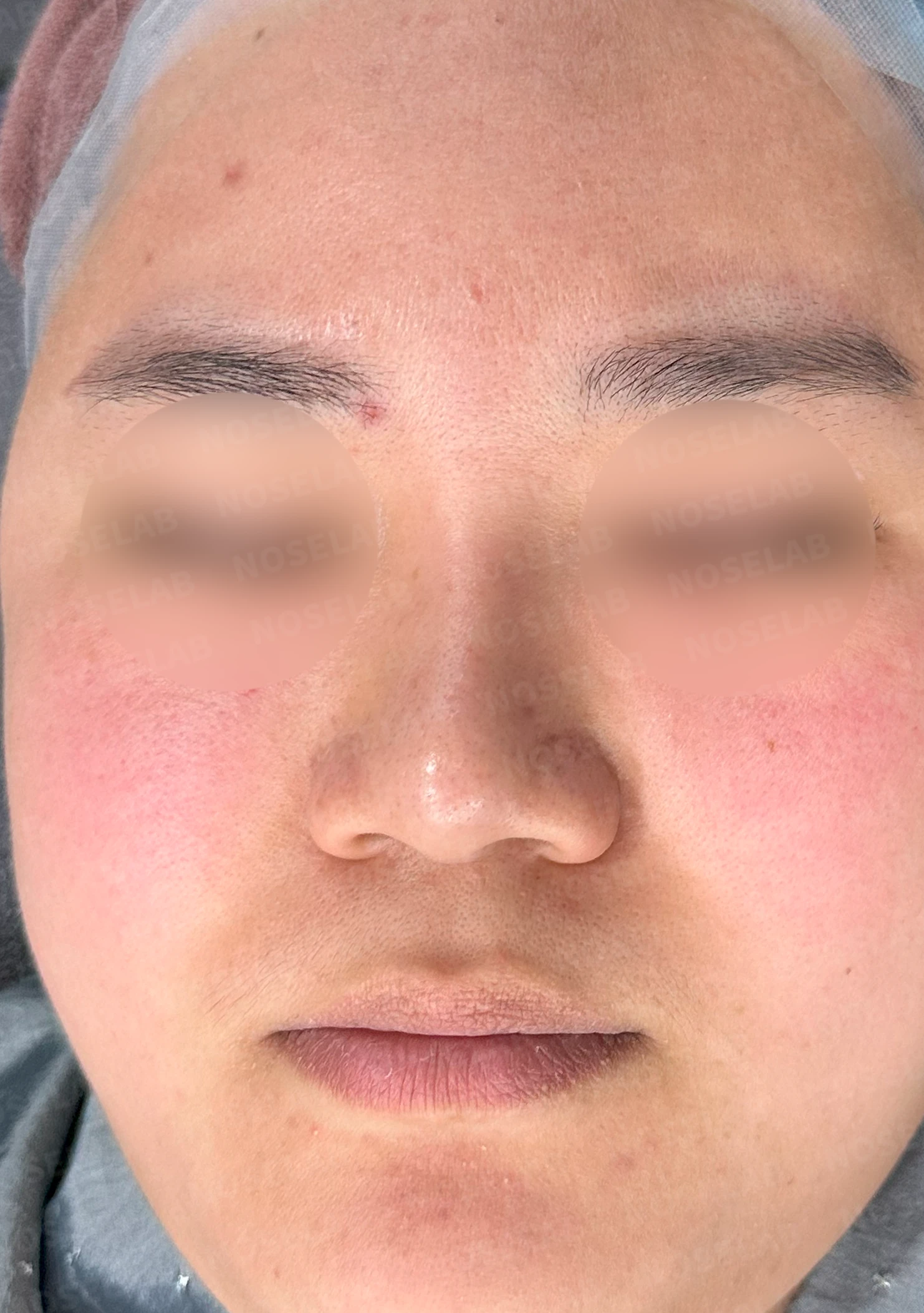 코에 삽입된 매선을 제거하고 재건하는 방법 — 수술 전 / 수술 직후 0일 직후 사진은 부기가 있는 상태로 최종 결과와 다를 수 있습니다.