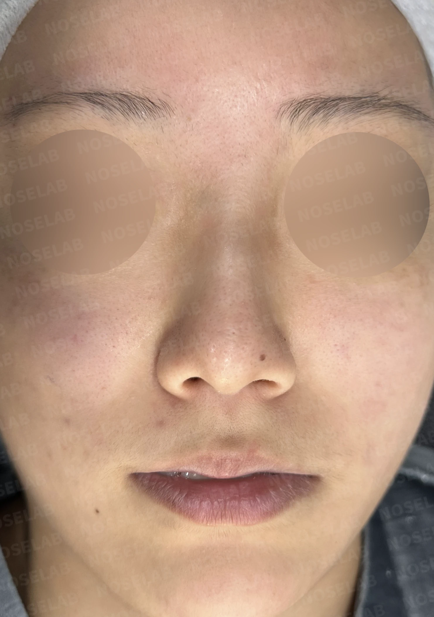 코필러 제거 후 자가늑연골 코성형, 처진 코끝과 메부리코를 자연스럽게 교정 — 전(좌) 직후(후)