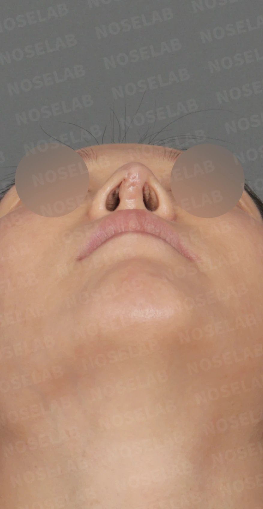 코끝 피부 함몰과 보형물 비침, 자가늑연골로 안전하게 복원한 코재수술 — 디자인 상담 — 우측 비스듬한 측면, 측면, 비공