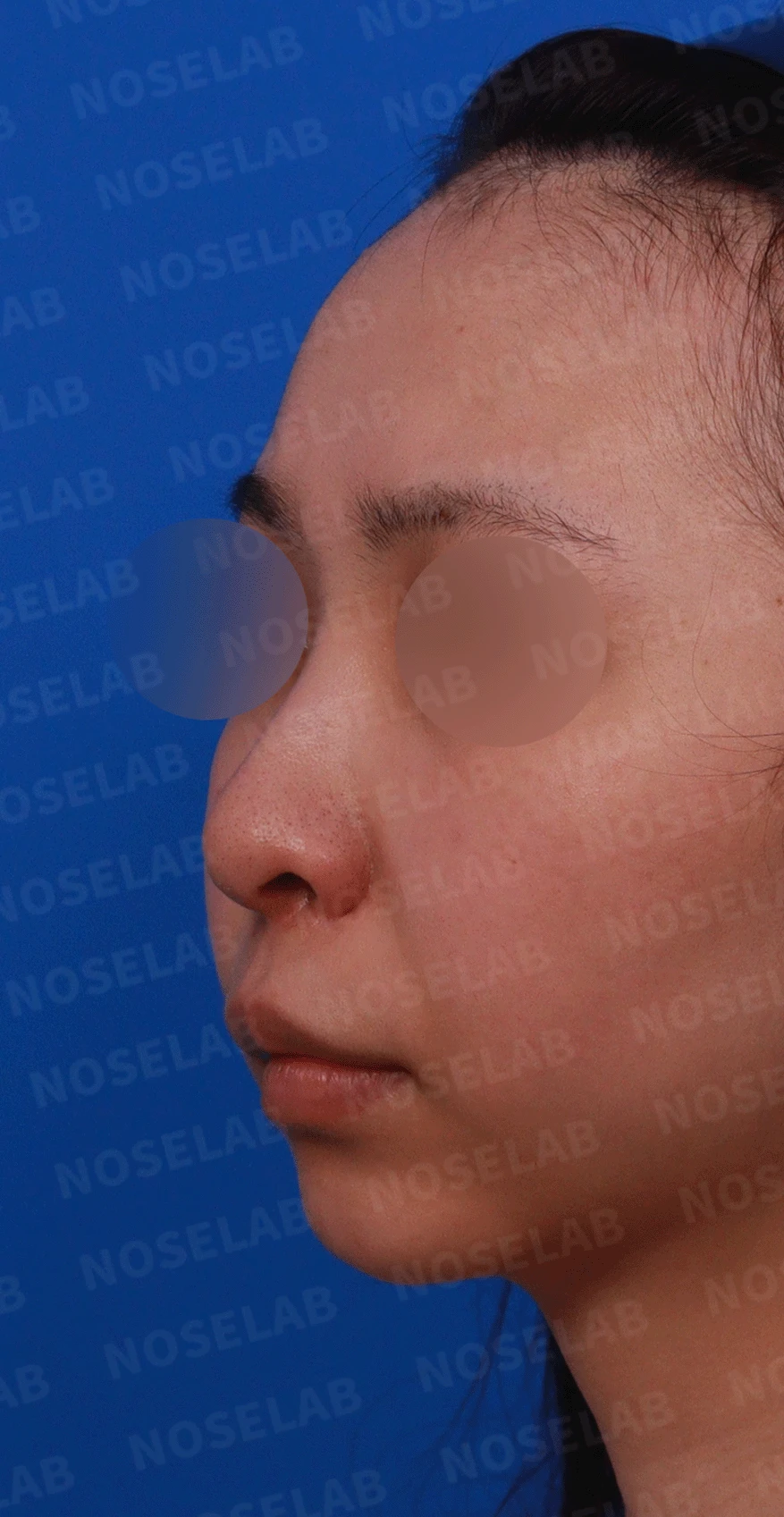 여러 번 수술해도 콧대가 낮고 복코가 남는 이유, 늑연골 재건과 얼굴 균형 — 디자인 상담 정면 , 좌측 비스듬한 측면 , 측면 사진입니다.