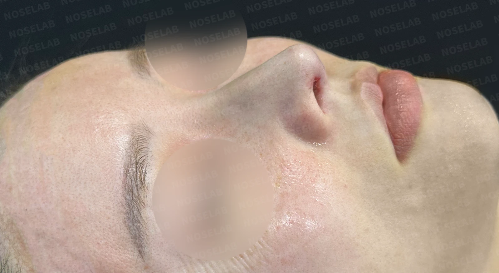 짧고 들린 코를 교정하는 재수술 방법 — 수술 전 / 수술 직후 0일 직후 사진은 부기가 있는 상태로 최종 결과와 다를 수 있습니다.