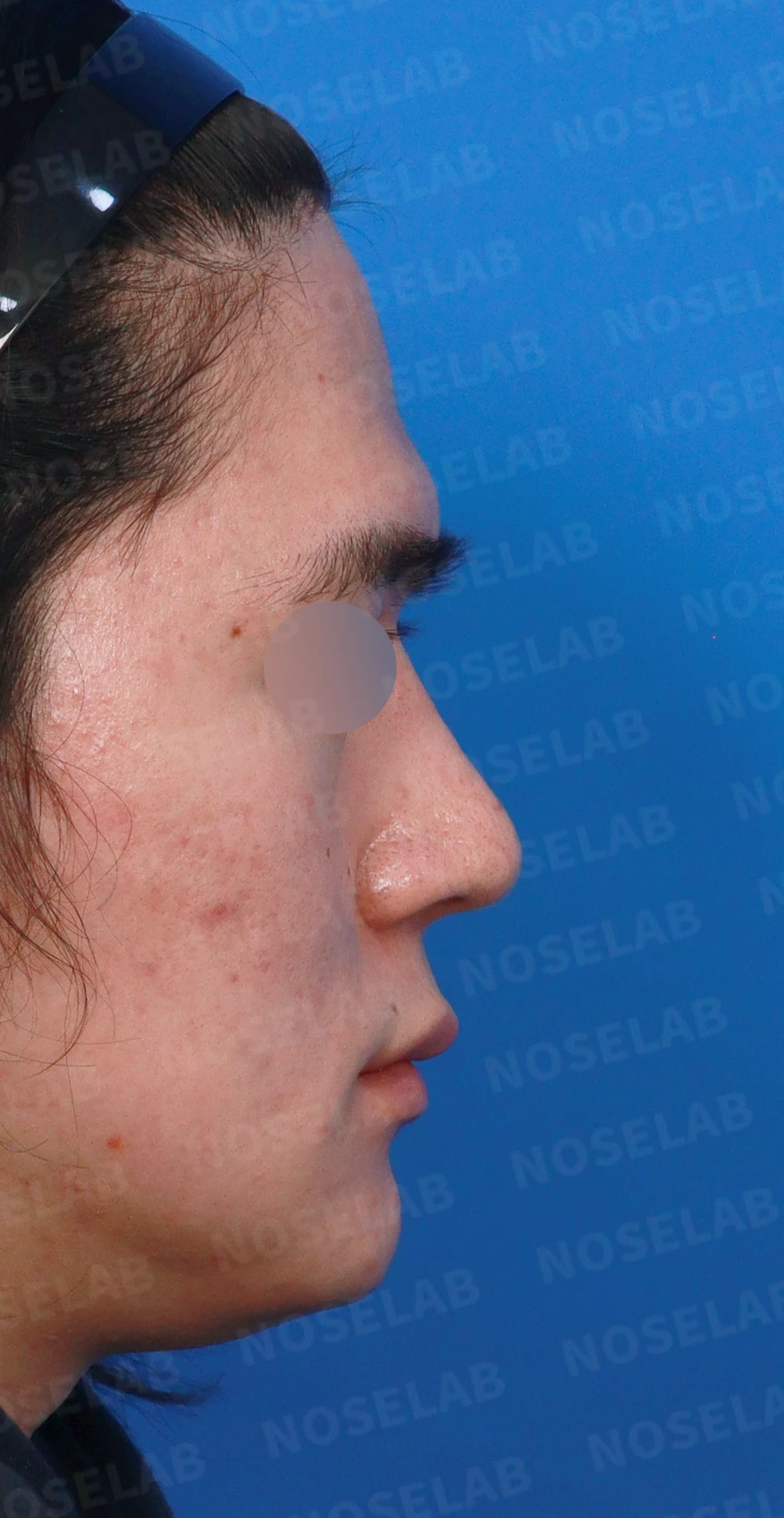 콧대를 더 높이고 싶을 때 무엇이 한계를 만드나, 3D 맞춤 보형물과 자가늑연골 코끝 지지 — 디자인 상담 우측 측면, 비스듬한 측면, 비공 사진입니다.