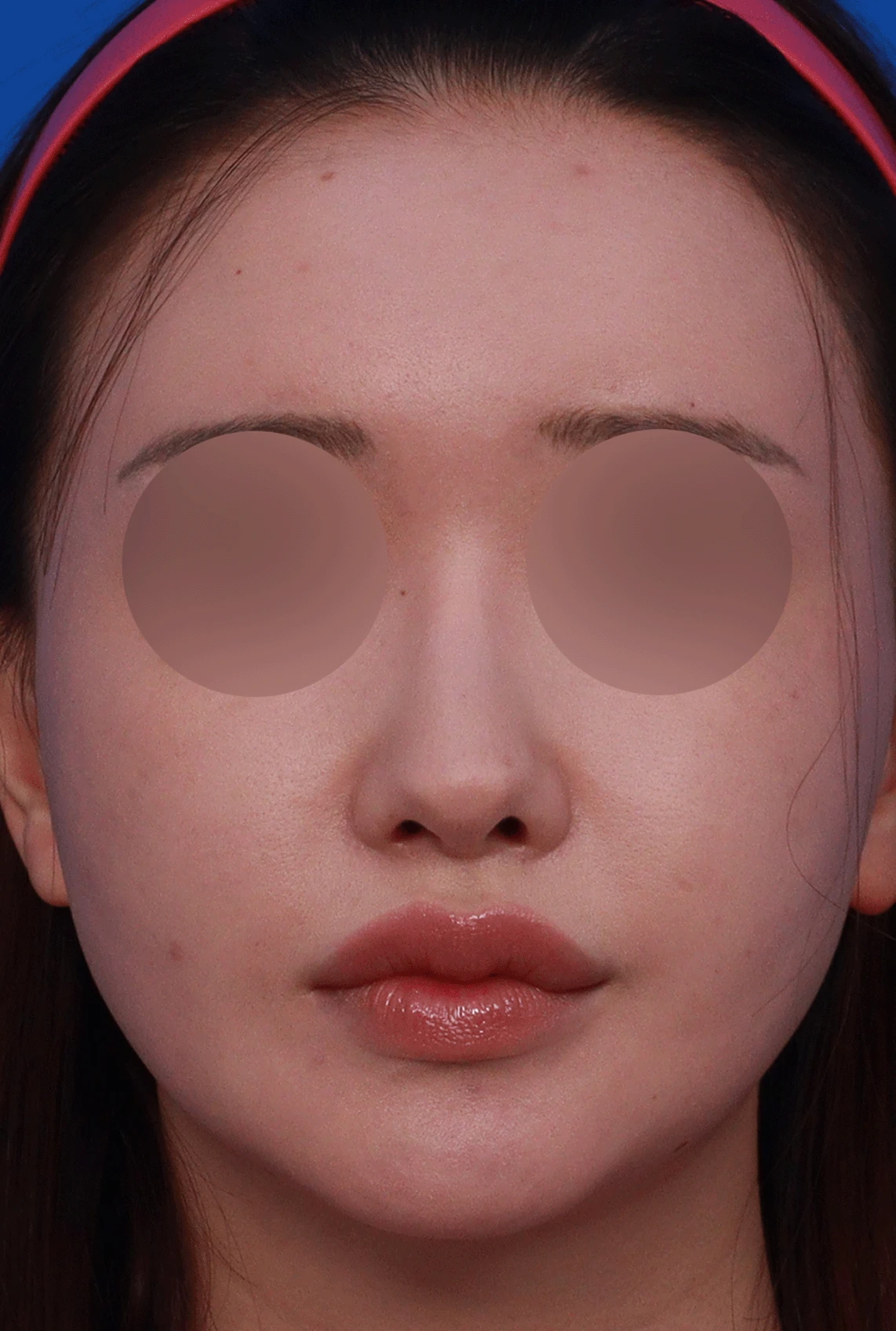 진피 이식 후 울퉁불퉁해진 콧대, 원인과 무보형물 재건 방법 — 디자인 상담 정면 , 좌측 비스듬한 측면 , 측면 사진입니다.