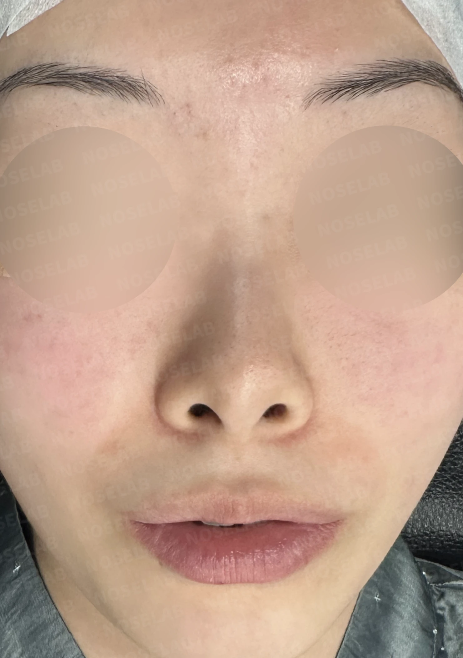 작고 낮은 코, 자가늑연골로 비순각 교정까지 한 번에 완성한 비개방 코성형 — 전(좌) 직후(후)