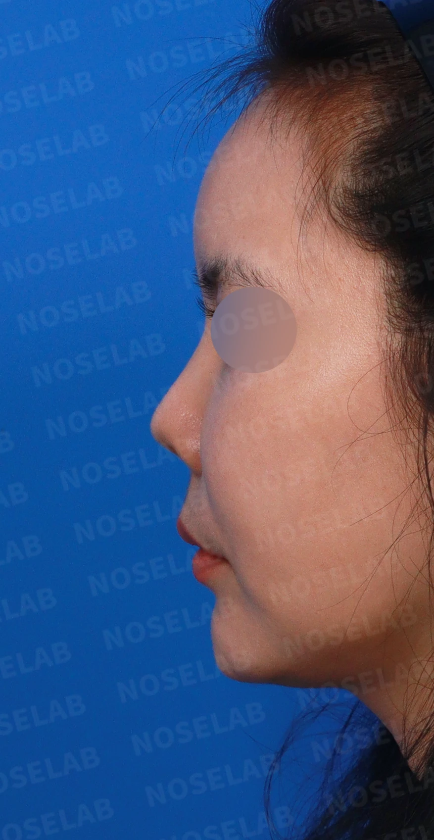 L자 실리콘 보형물이 비주 점막을 뚫기 직전까지 가는 이유, 제거와 자가늑연골 재건 방법 — 디자인 상담 정면, 좌측 측면, 비스듬한 측면 사진