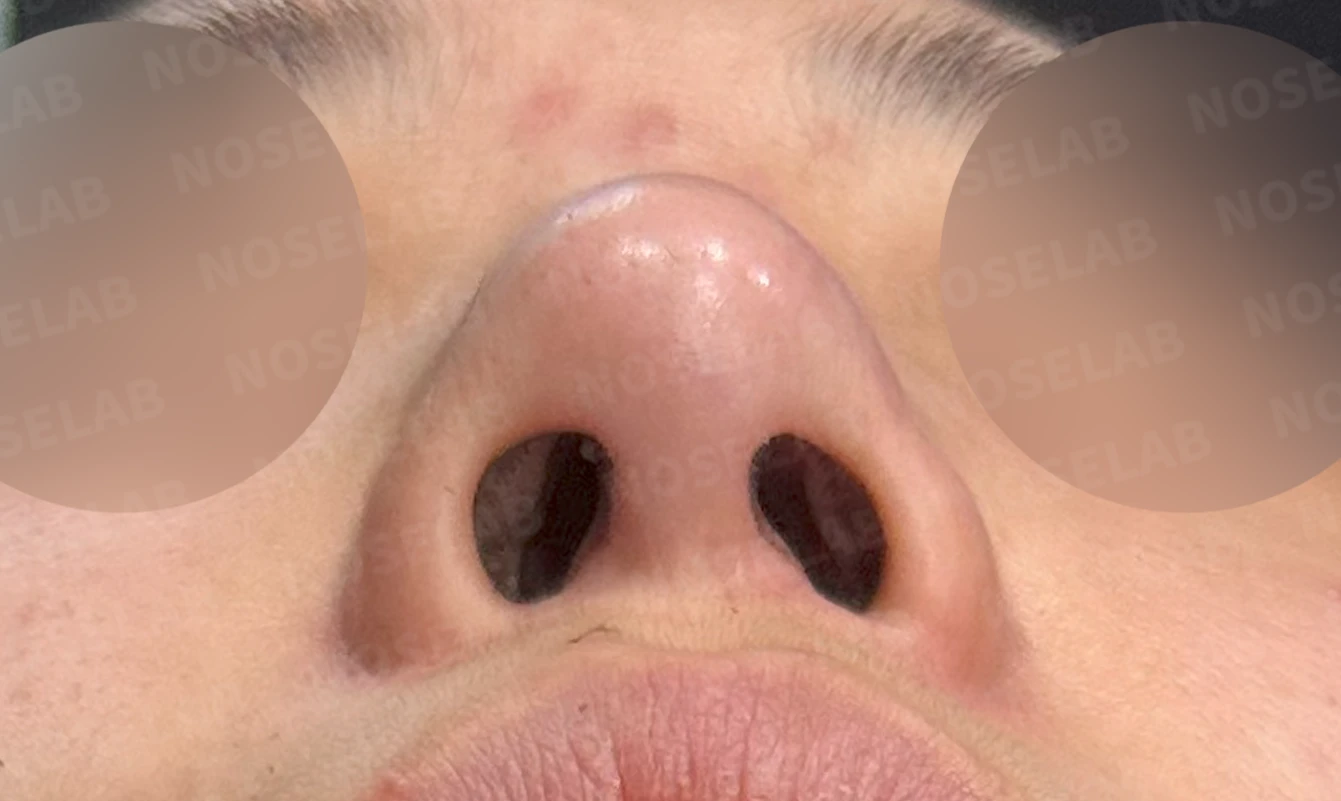 휘어진 코 교정과 비염 개선 - 자가늑연골 재건술 후기 — 전(좌) 직후(우)