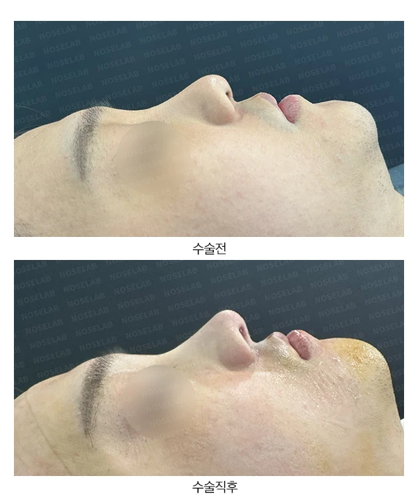 실리콘 부작용과 퍼진 코의 재수술 방법 — 본문 사진 19