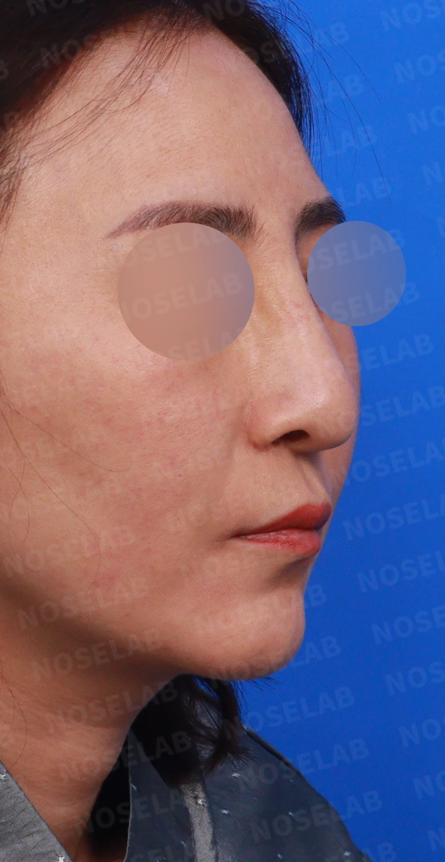 무자격 불법 주사 뒤 콧구멍이 좁아지는 이유와 제거·재건 방법 — 디자인 상담 우측 비스듬한 측면, 측면, 비공 사진입니다.