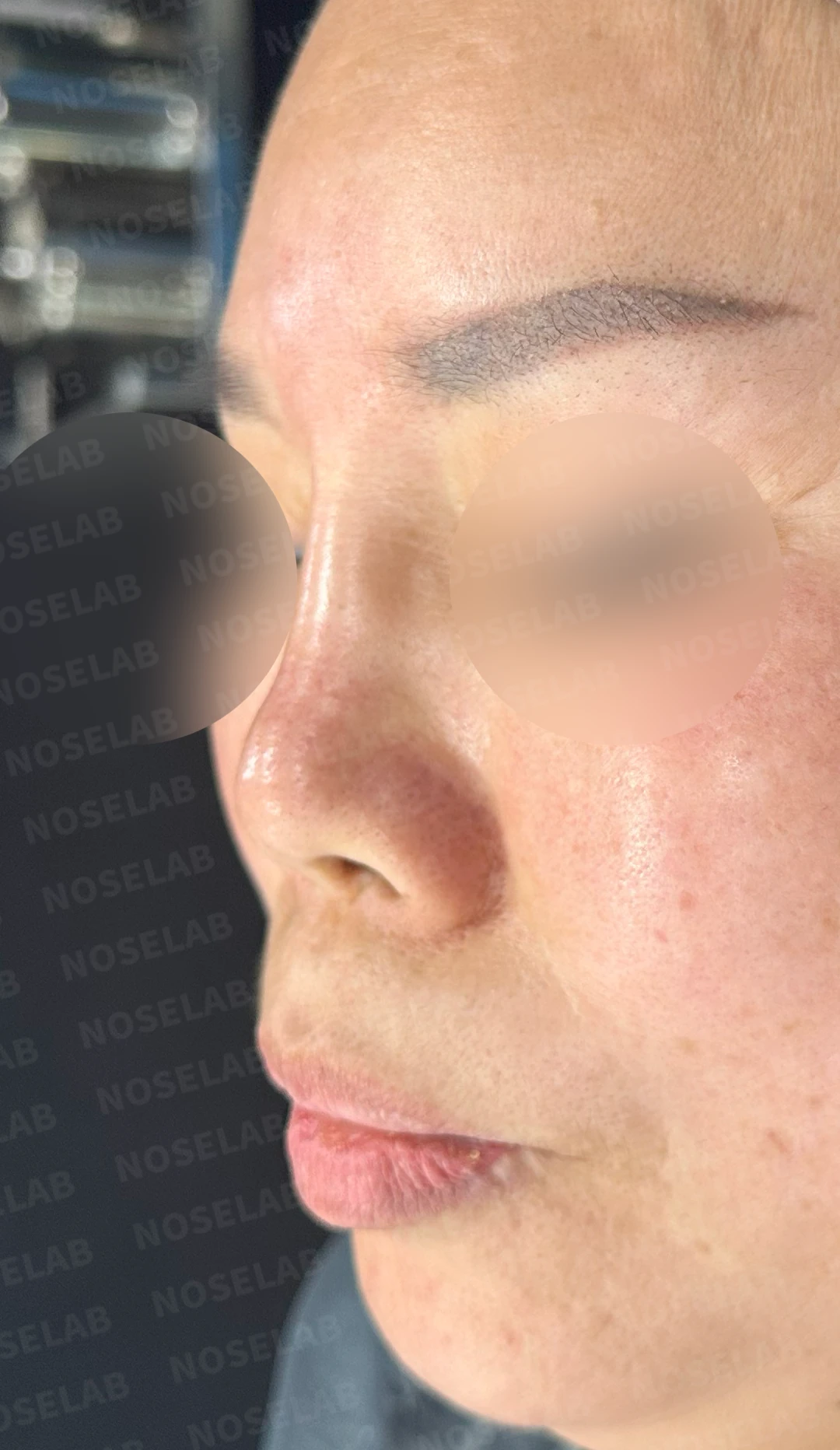 불법 주사 시술 뒤 코가 들리고 짧아지는 이유, 이물질 제거와 재건은 어떻게 하나 — 수술 전 / 수술 직후 0일 직후 사진은 부기가 있는 상태로 최종 결과와 다를 수 있습니다.