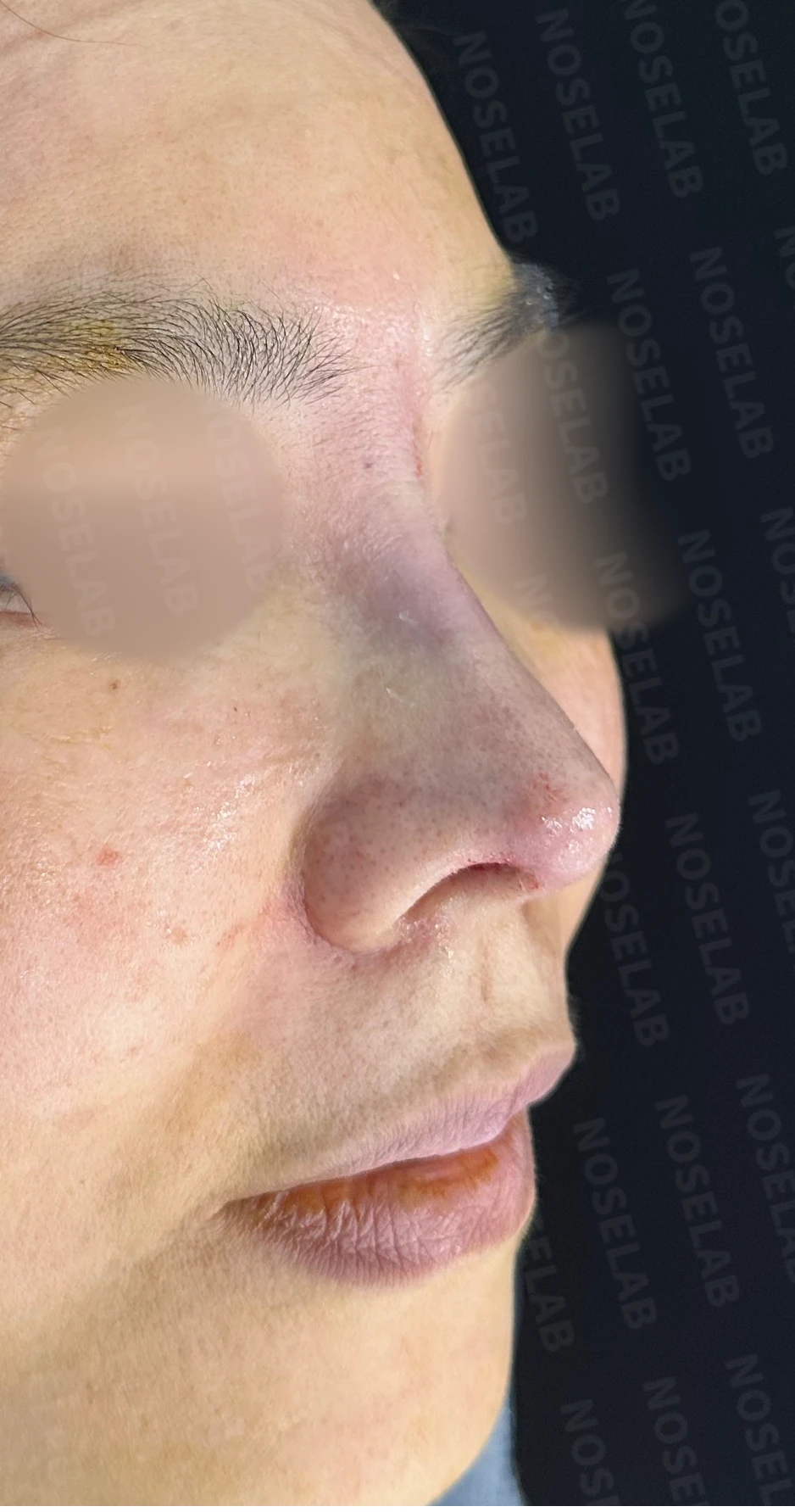 뭉툭하고 처진 긴코 교정 방법 — 수술 직후 0일 사진 90도, 45도, 정면 직후 사진은 부기가 있는 상태로 최종 결과와 다를 수 있습니다.