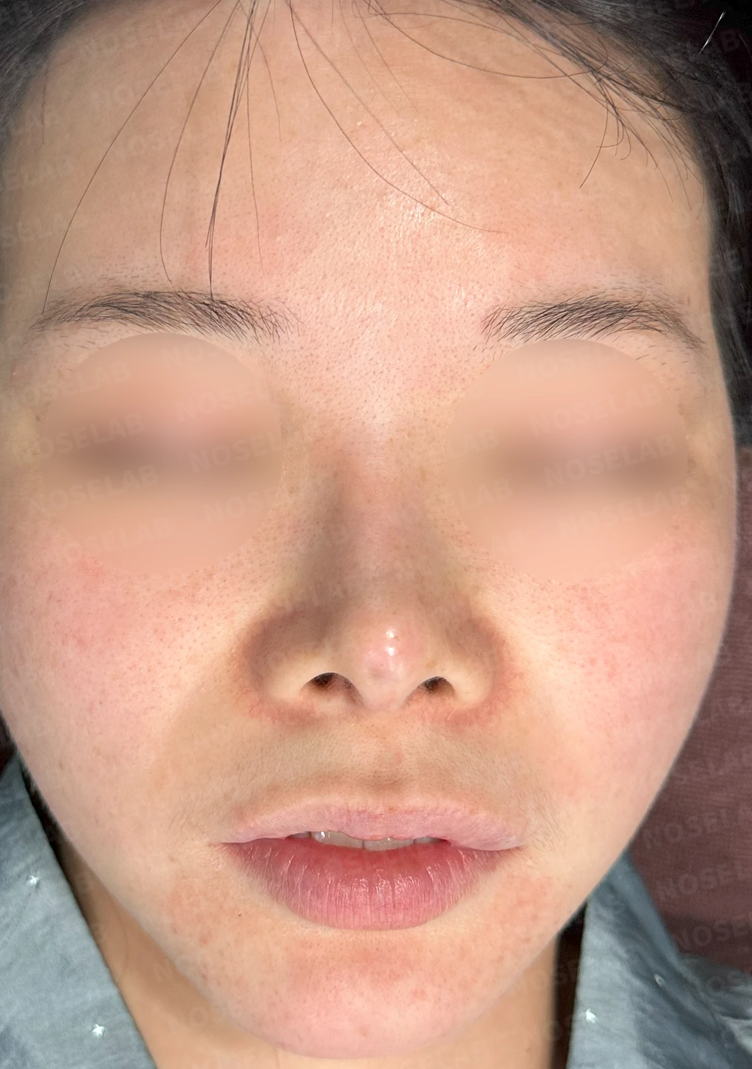 코끝 피부 상태와 괴사 위험을 고려한 재수술 계획 — 수술 전 / 수술 직후 0일 직후 사진은 부기가 있는 상태로 최종 결과와 다를 수 있습니다.