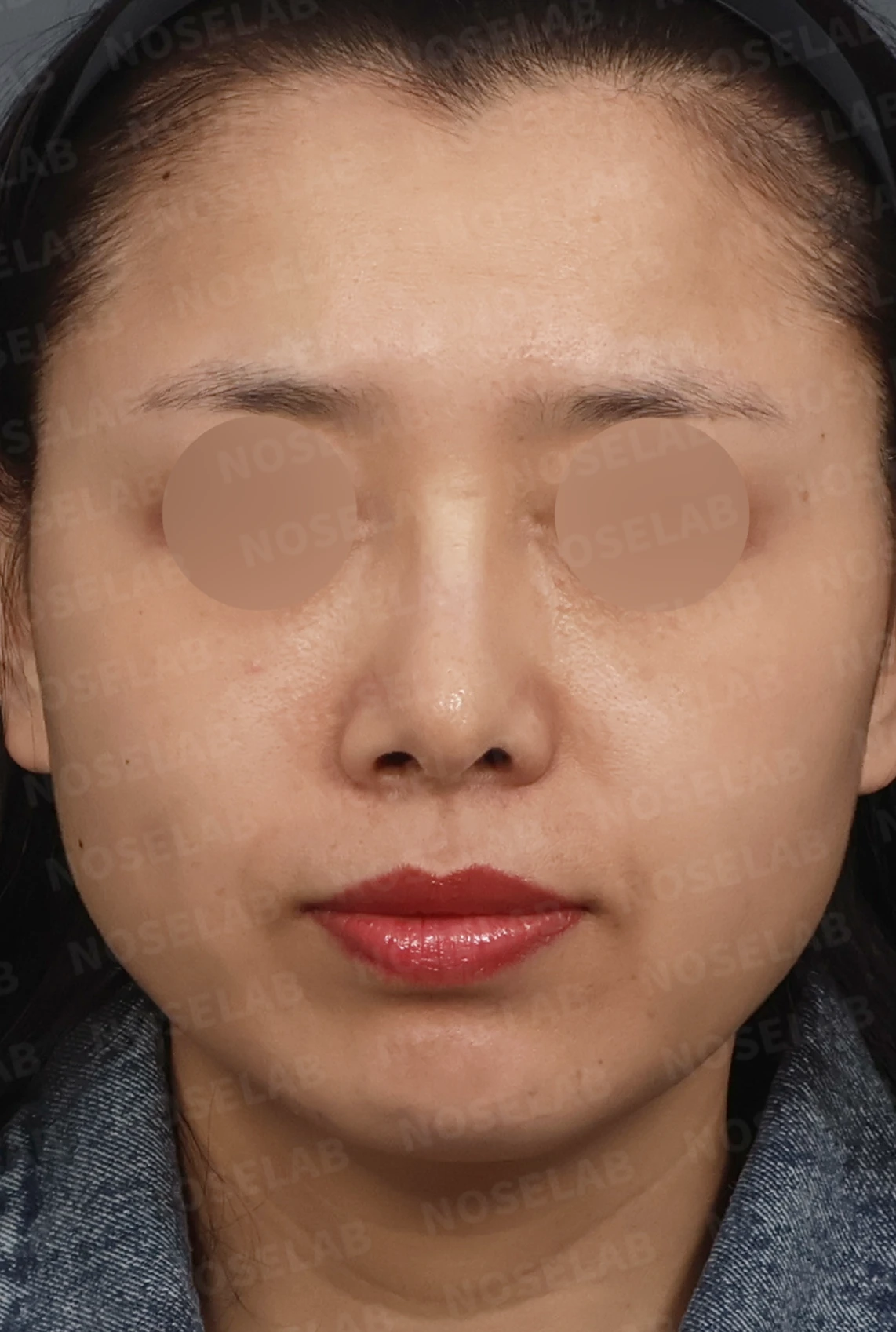 비공 비대칭과 휘어진 코, 자가늑연골 재건으로 교정한 코재수술 — 디자인 상담 정면, 좌측 측면, 비스듬한 측면 사진