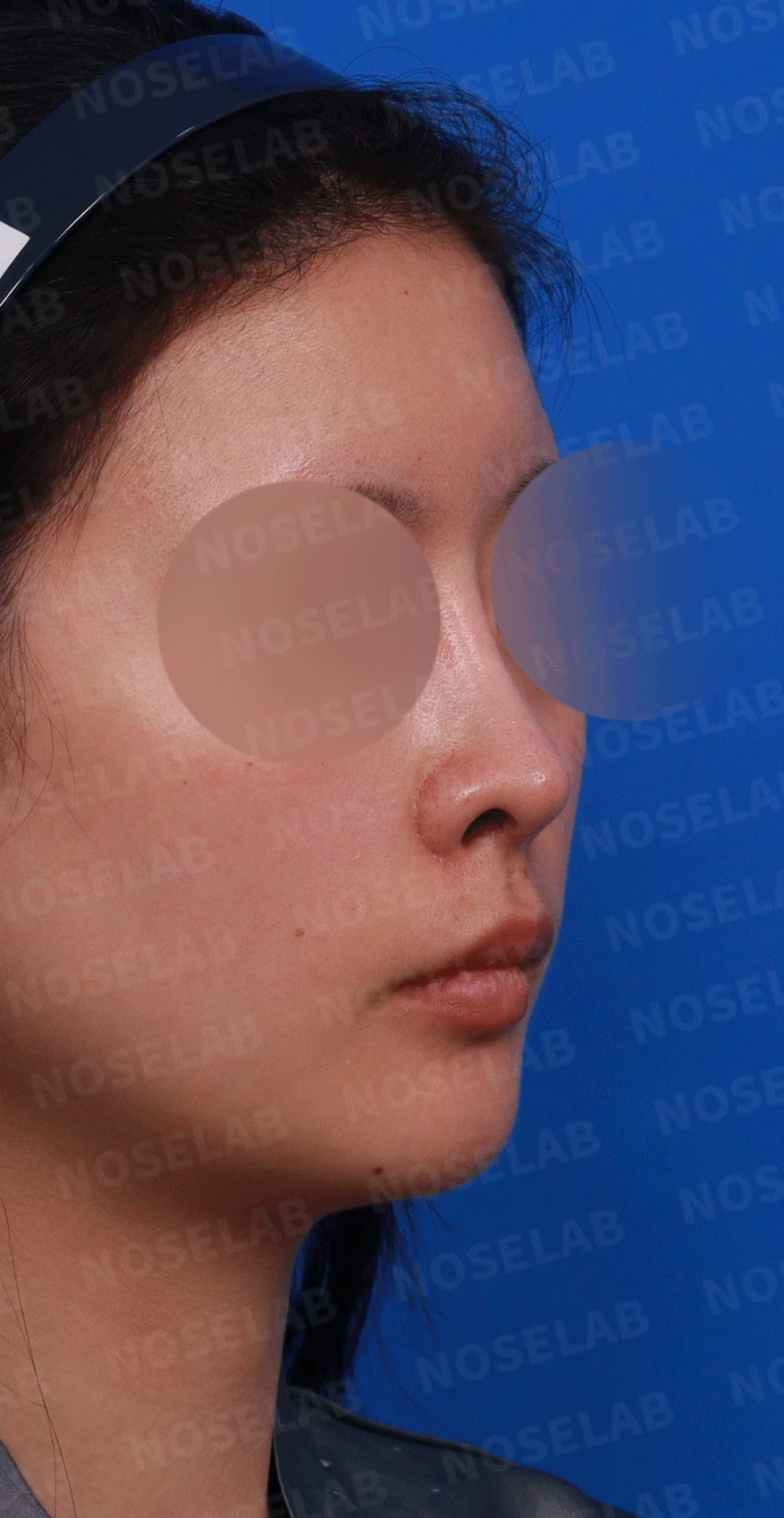 콧대가 인위적으로 보이고 코가 들리는 이유, 재건은 어떻게 하나 — 디자인 상담 비스듬한 측면 , 우측 측면, 비공 사진